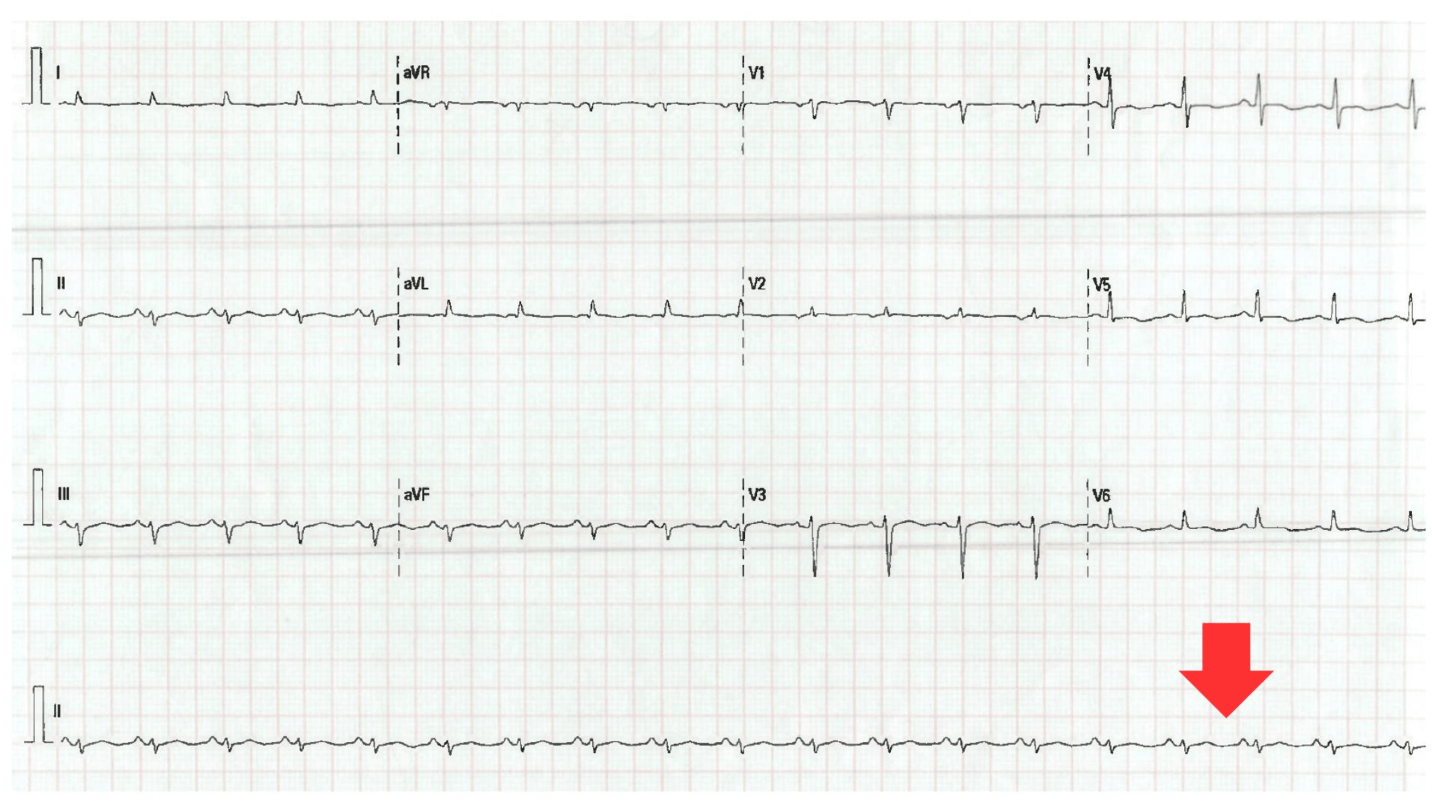 ECG showing low voltage in limb leads