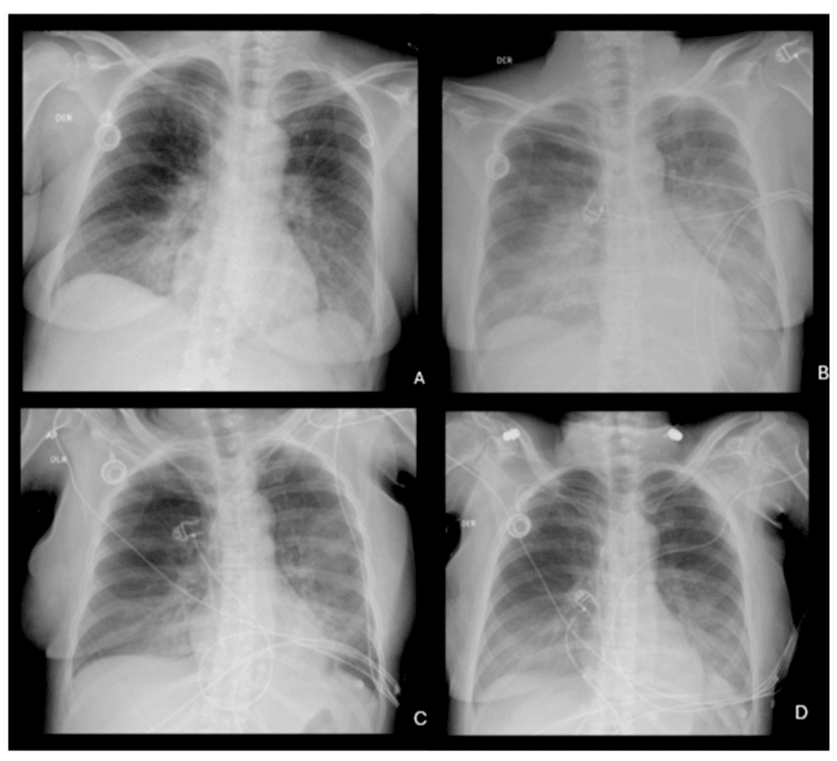Serial chest X-rays showing pulmonary congestion and resolution