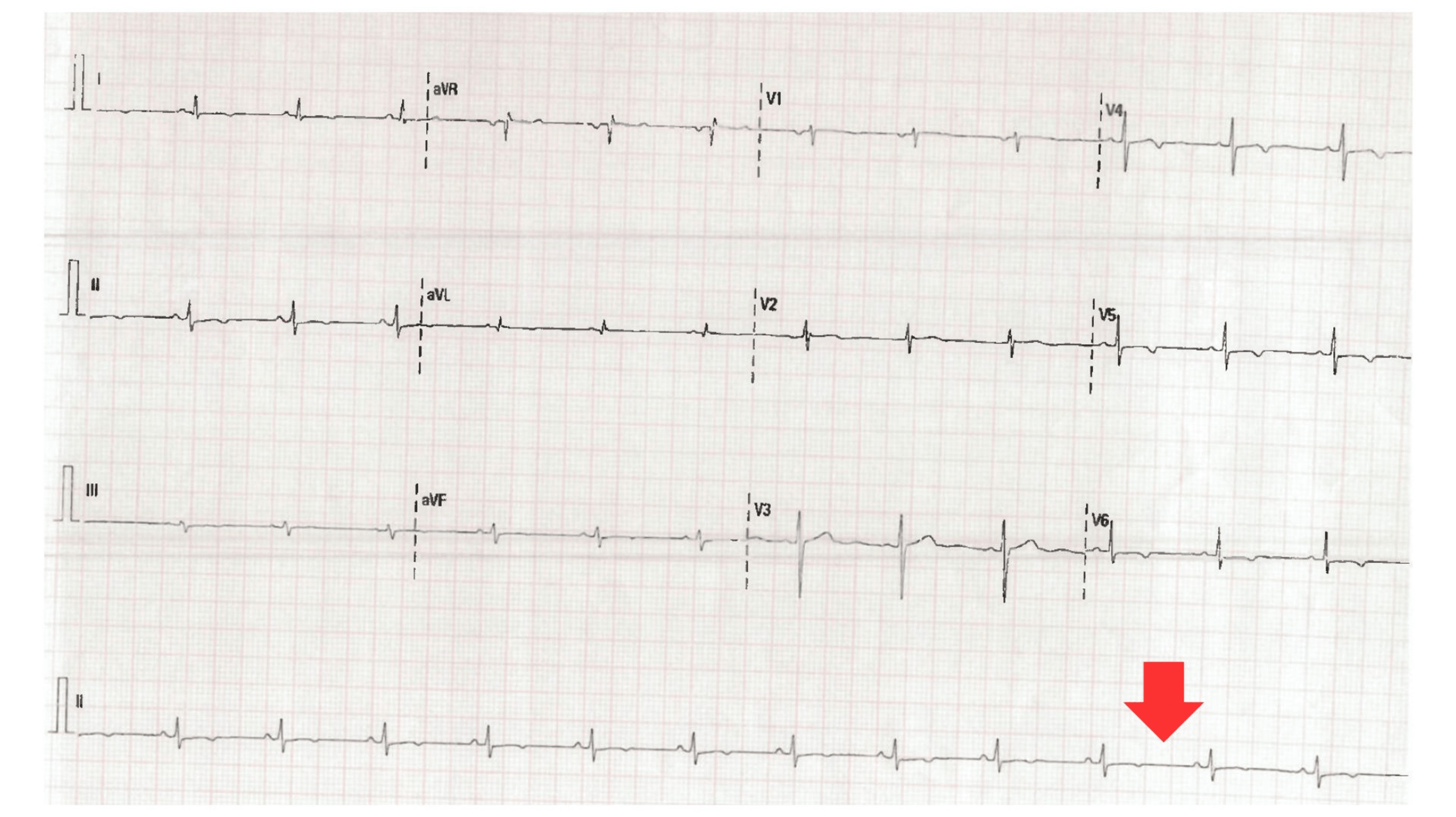 ECG showing normalization of QRS voltage at recovery