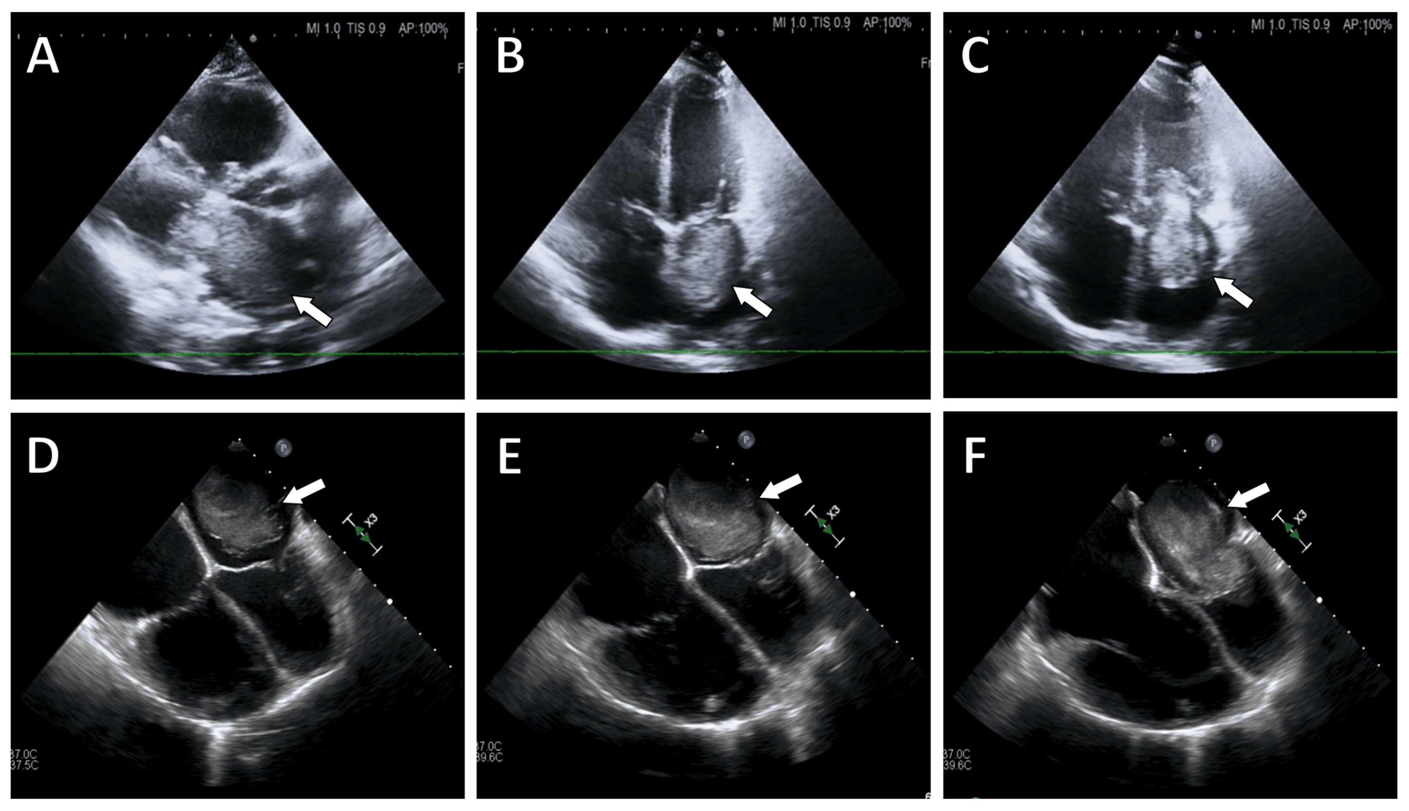Echocardiographic images of left atrial myxoma