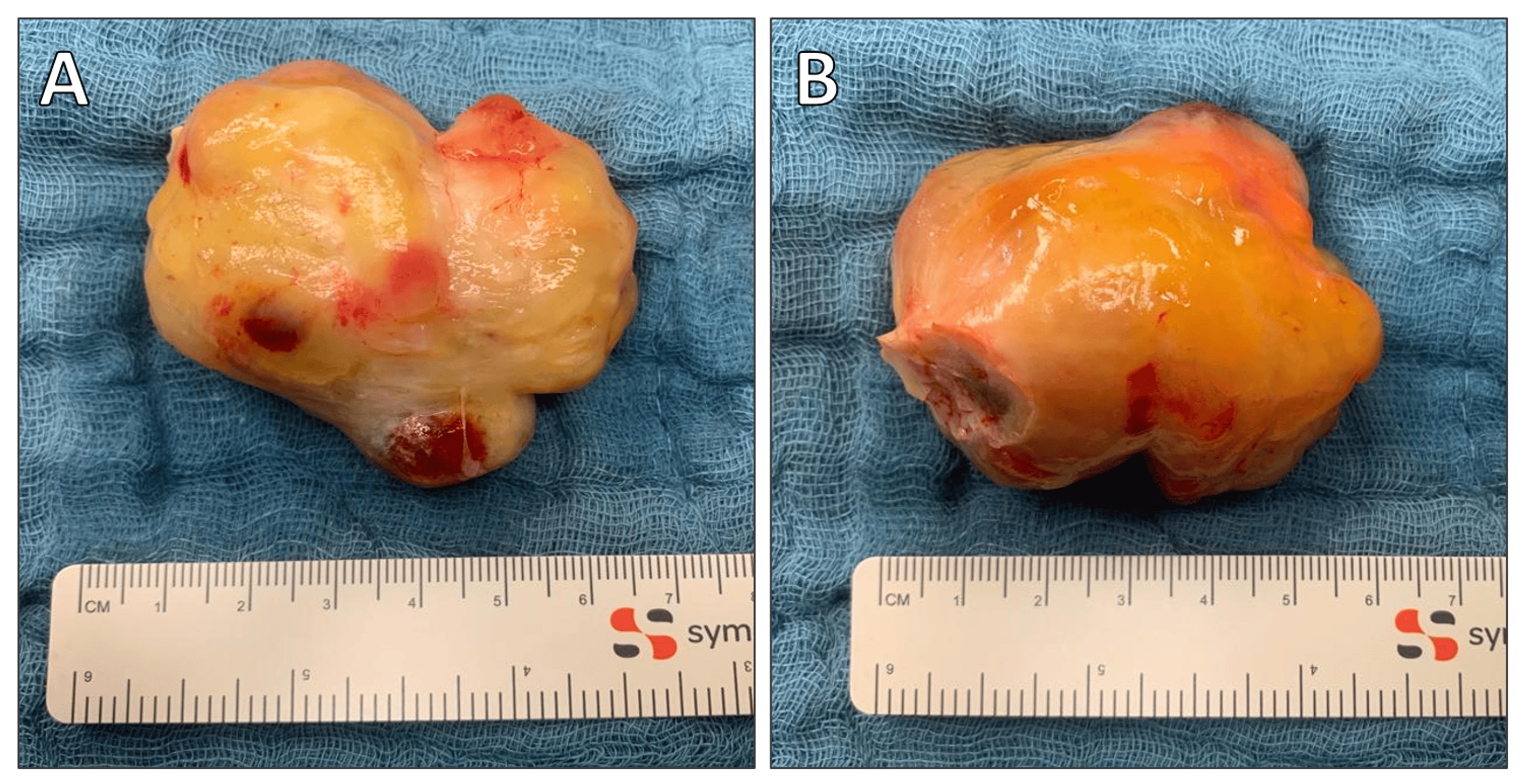 Excised left atrial myxoma