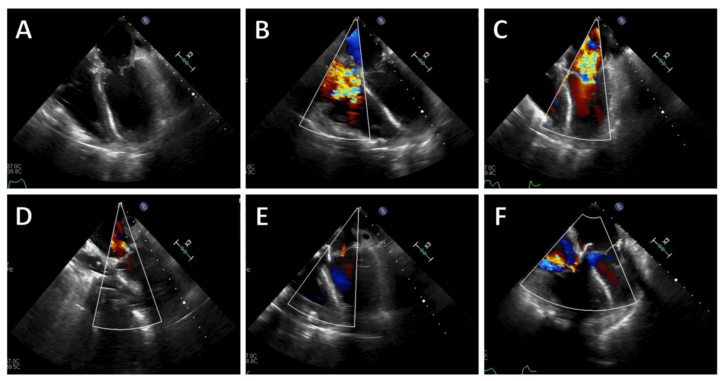 Intraoperative TEE after myxoma removal