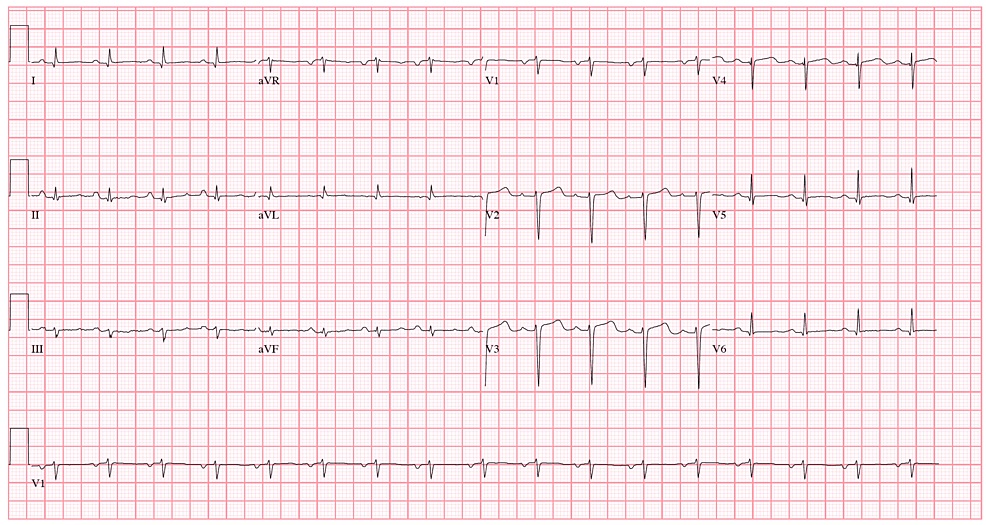12-lead EKG demonstrating low voltage and left atrial enlargement