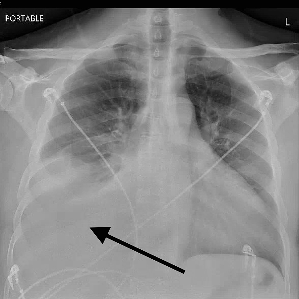 Chest X-ray with right-sided pleural effusion