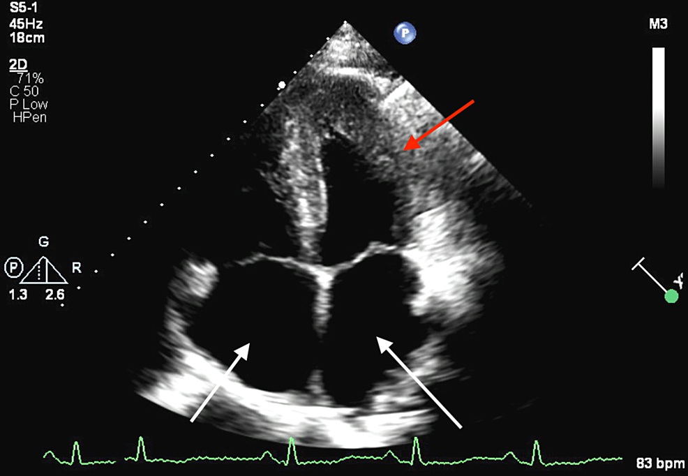 Apical four-chamber view showing LVH and biatrial enlargement