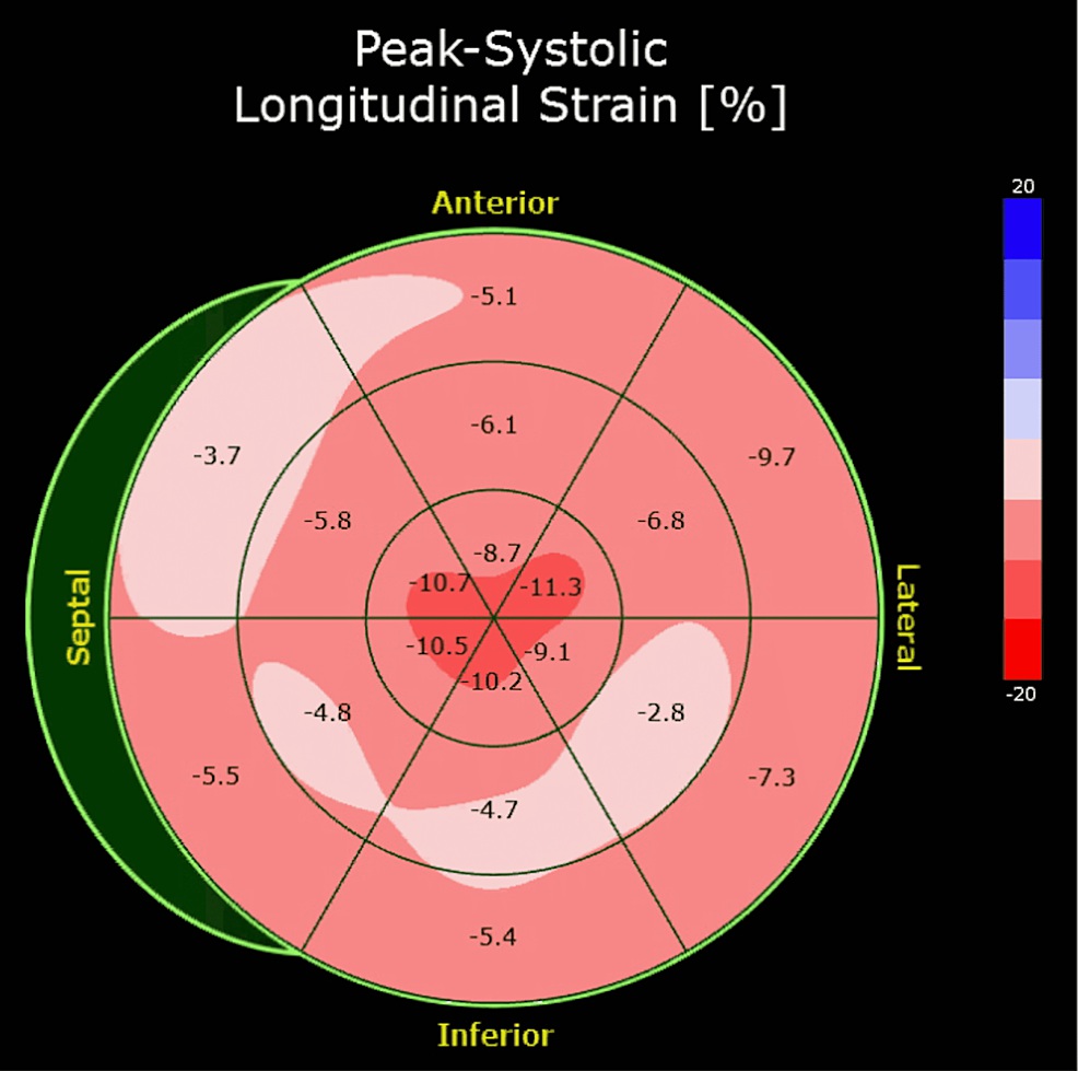 Global longitudinal strain pattern demonstrating apical sparing