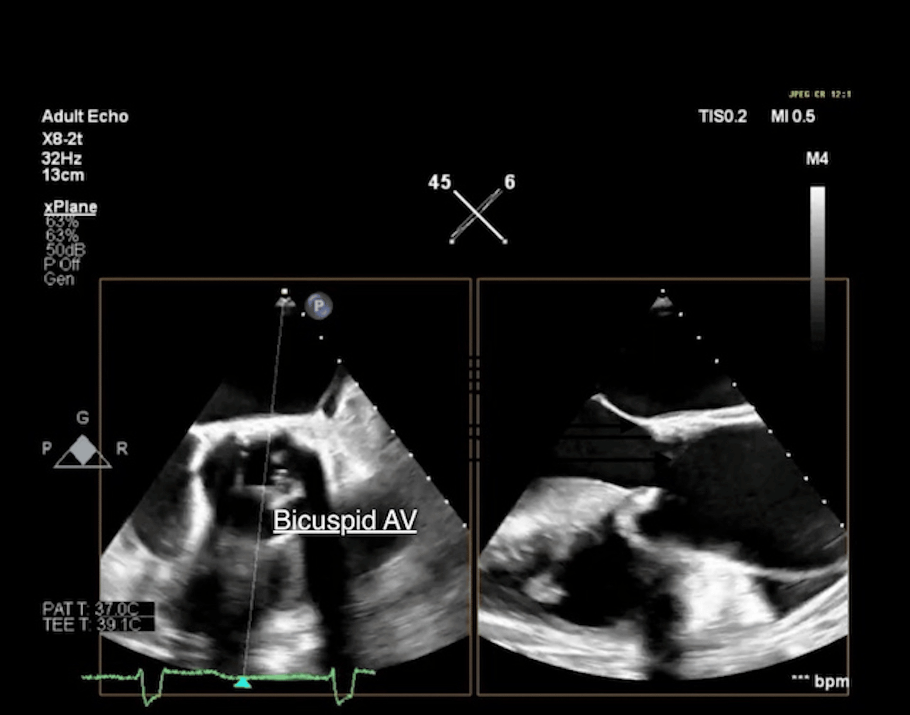 Transesophageal echocardiogram showing bicuspid aortic valve