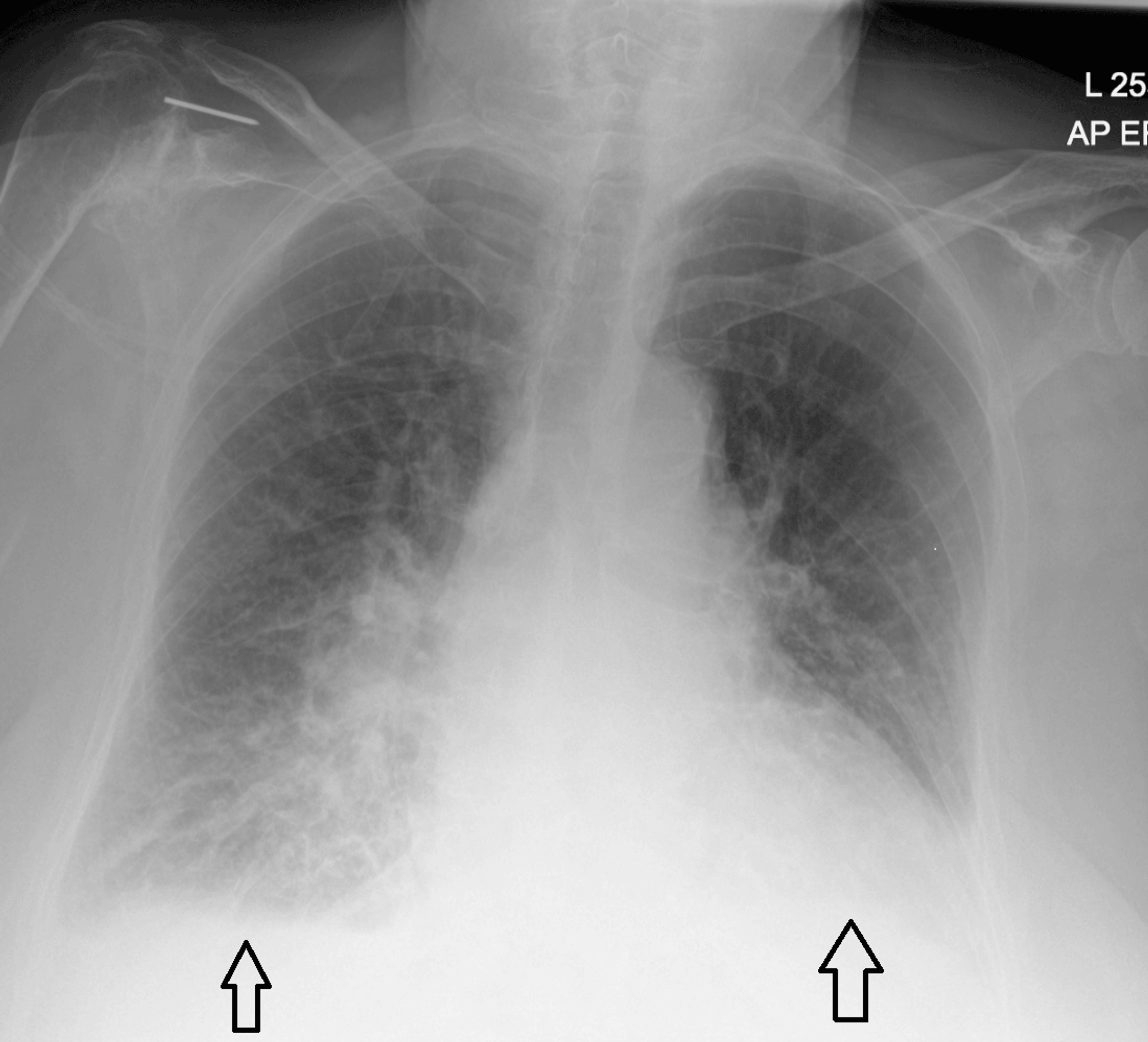 Chest X-ray on admission showing bilateral pulmonary congestion