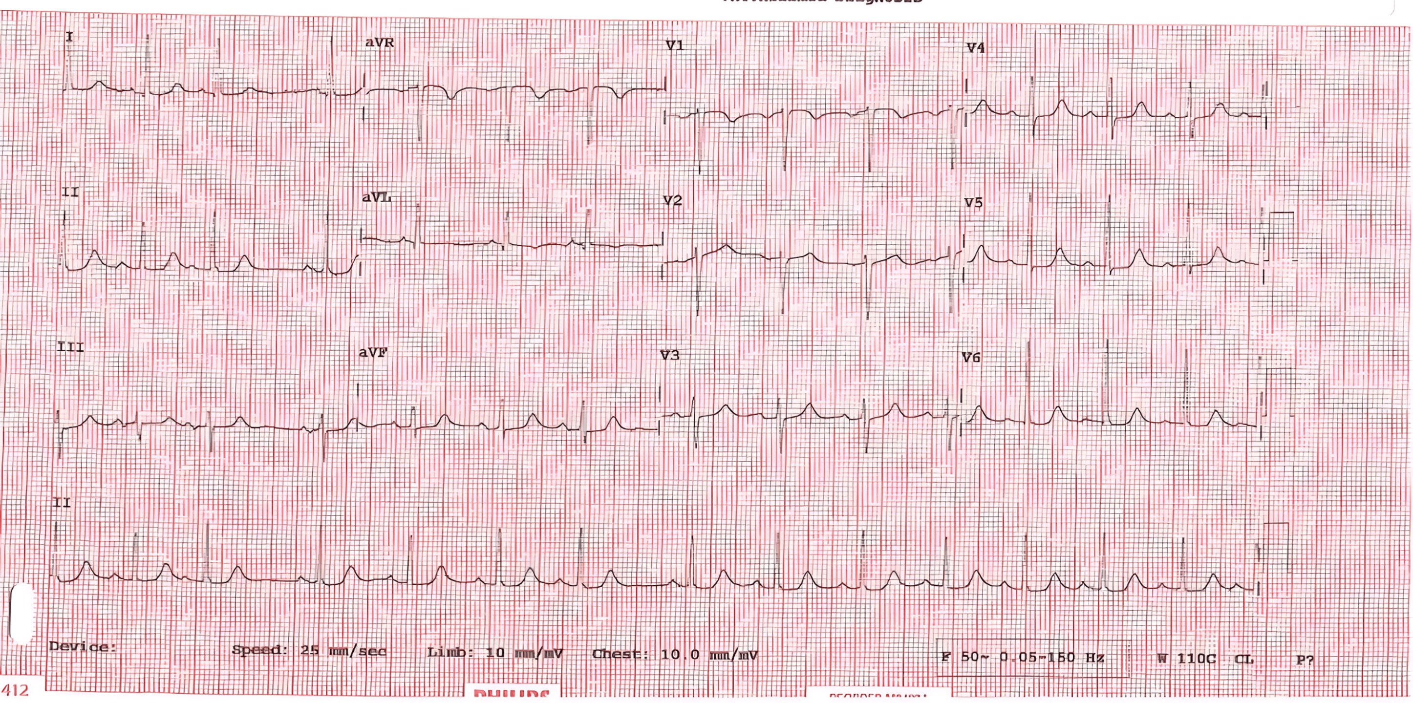 ECG showing no features of ischemia