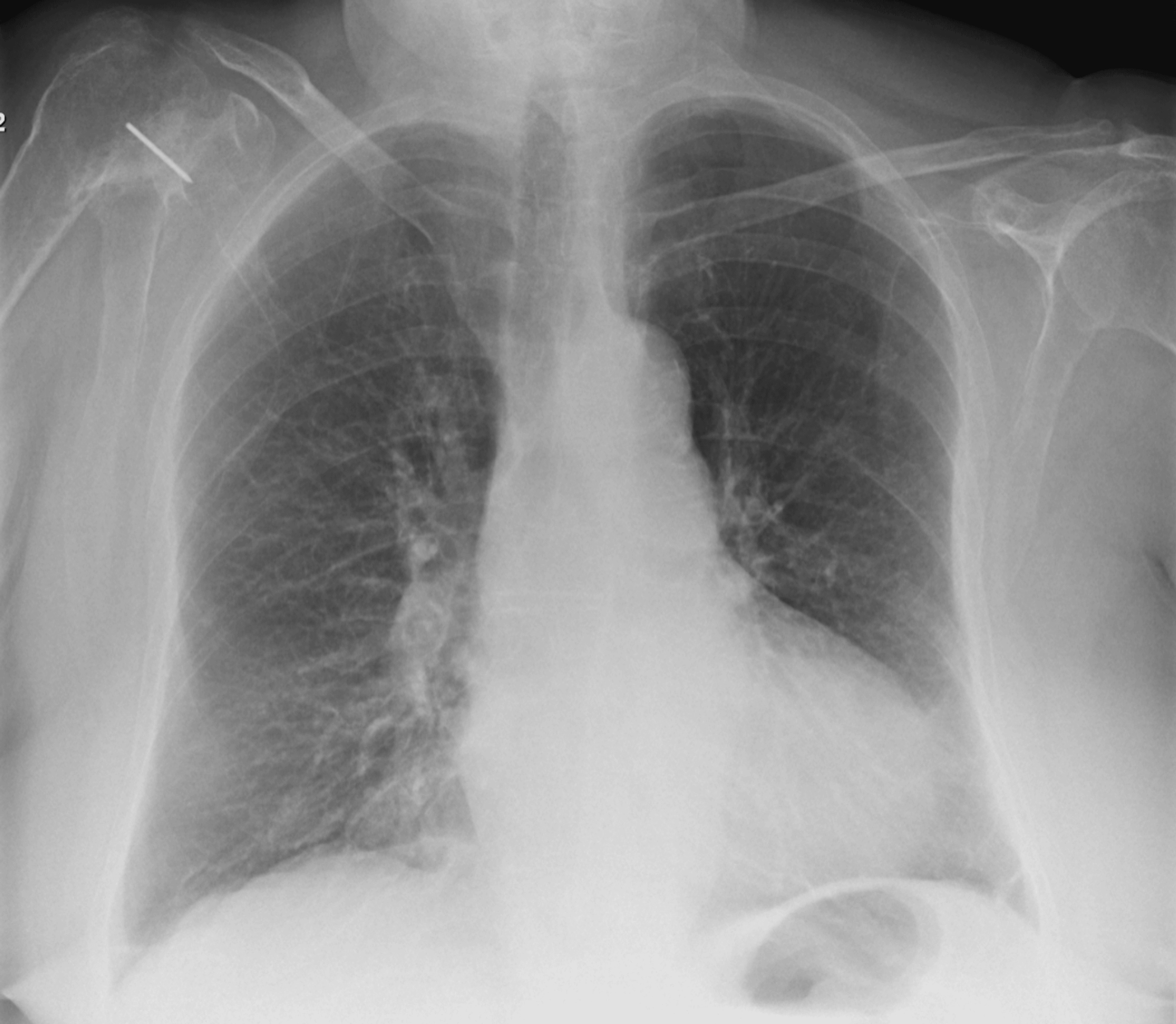 Chest X-ray three months prior to admission