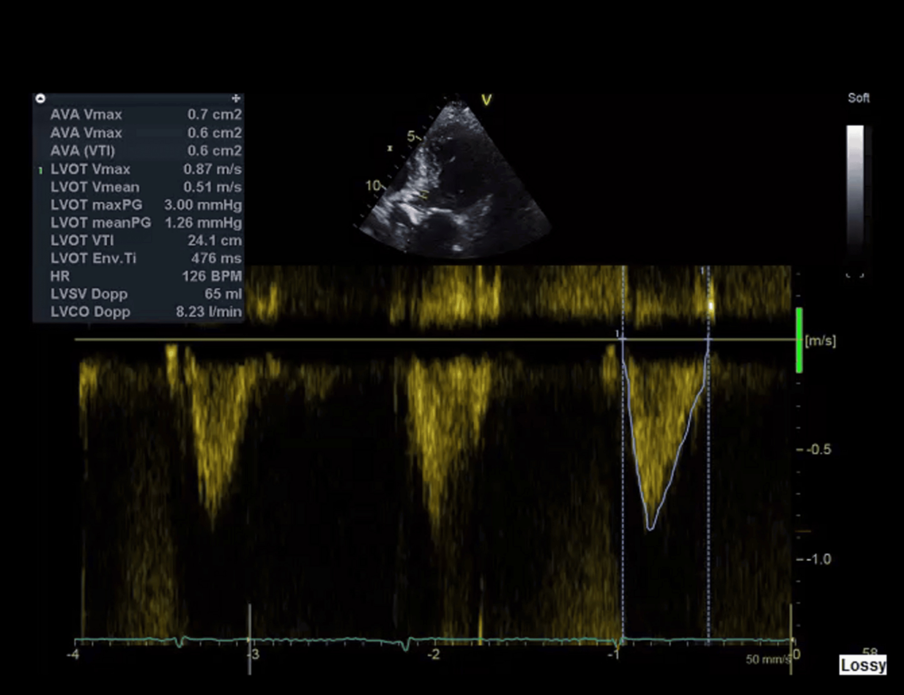 Echocardiograph showing indexed aortic valve area 0.6 cm²