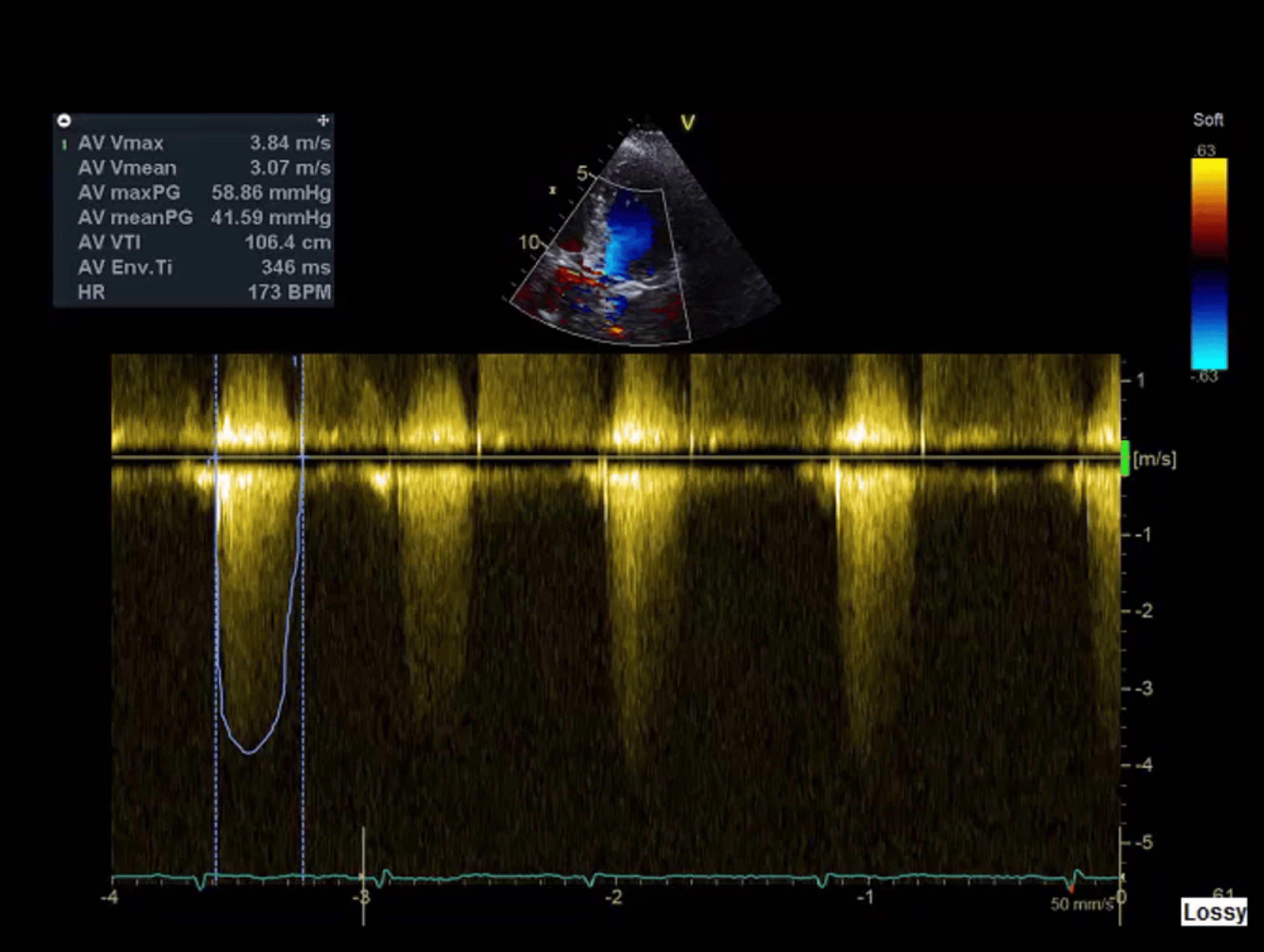 Echocardiograph showing peak velocity 3.84 m/s and mean gradient >40 mmHg