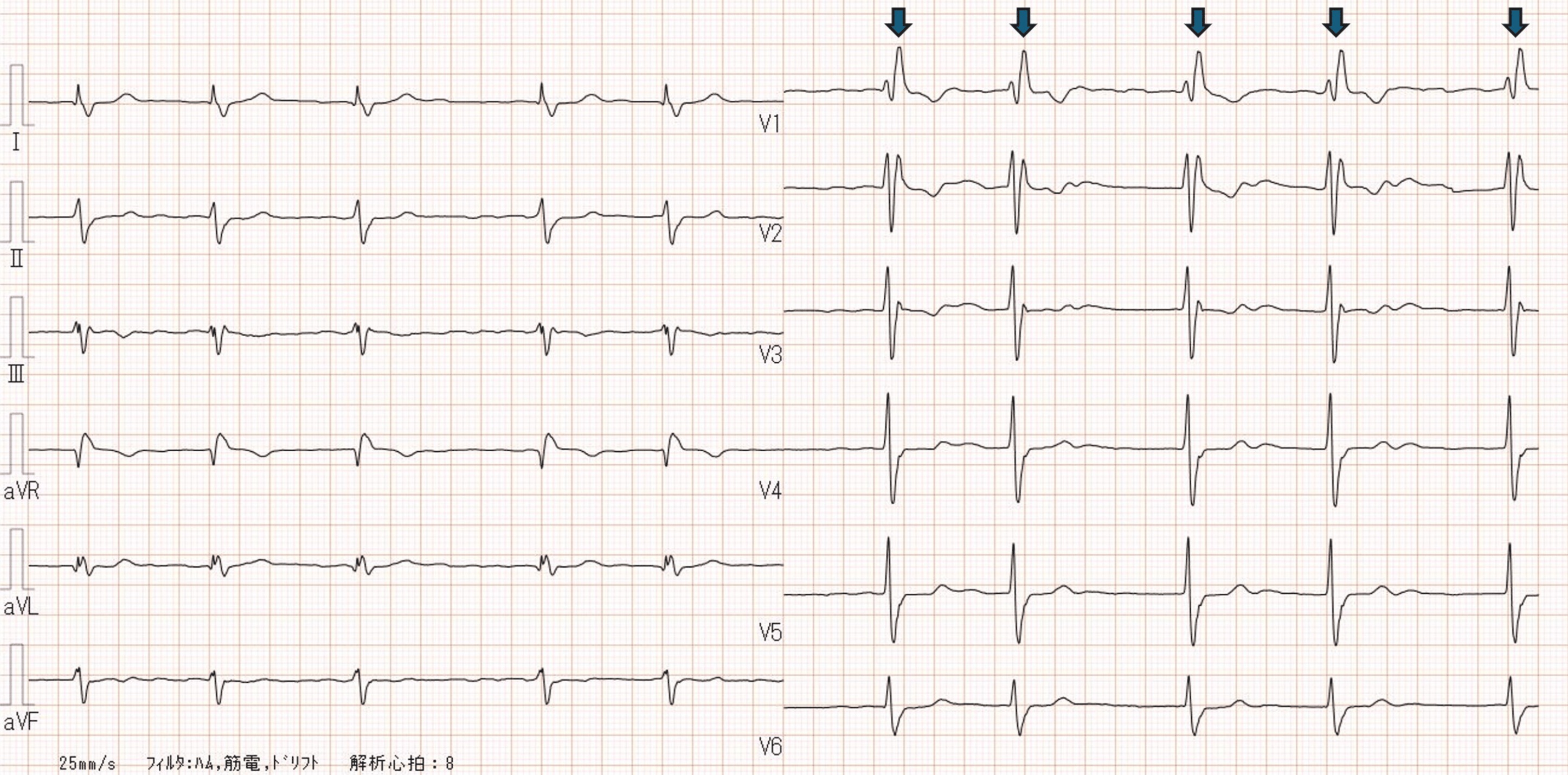 Preoperative electrocardiogram