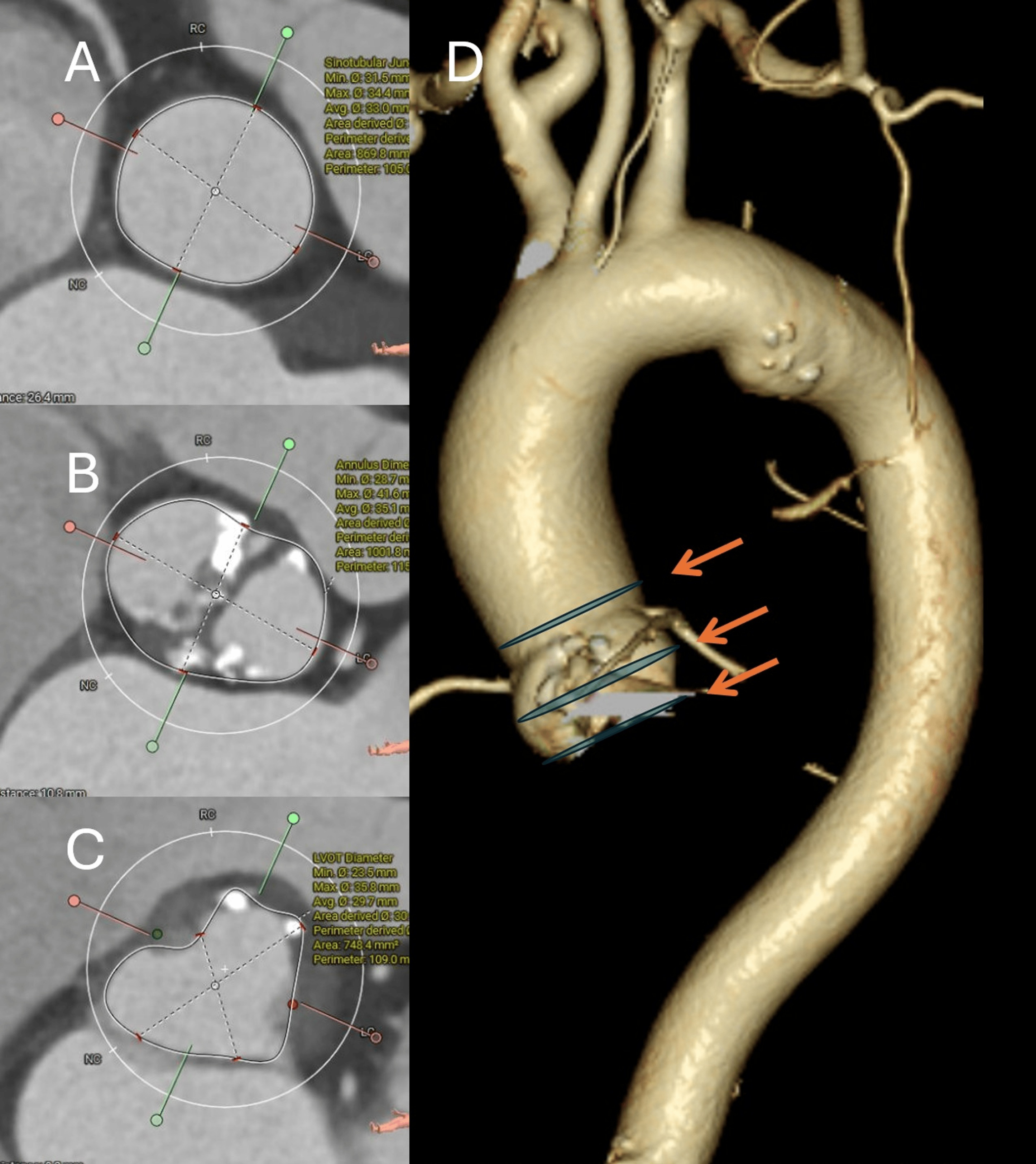 Preoperative CT images showing elliptical annulus