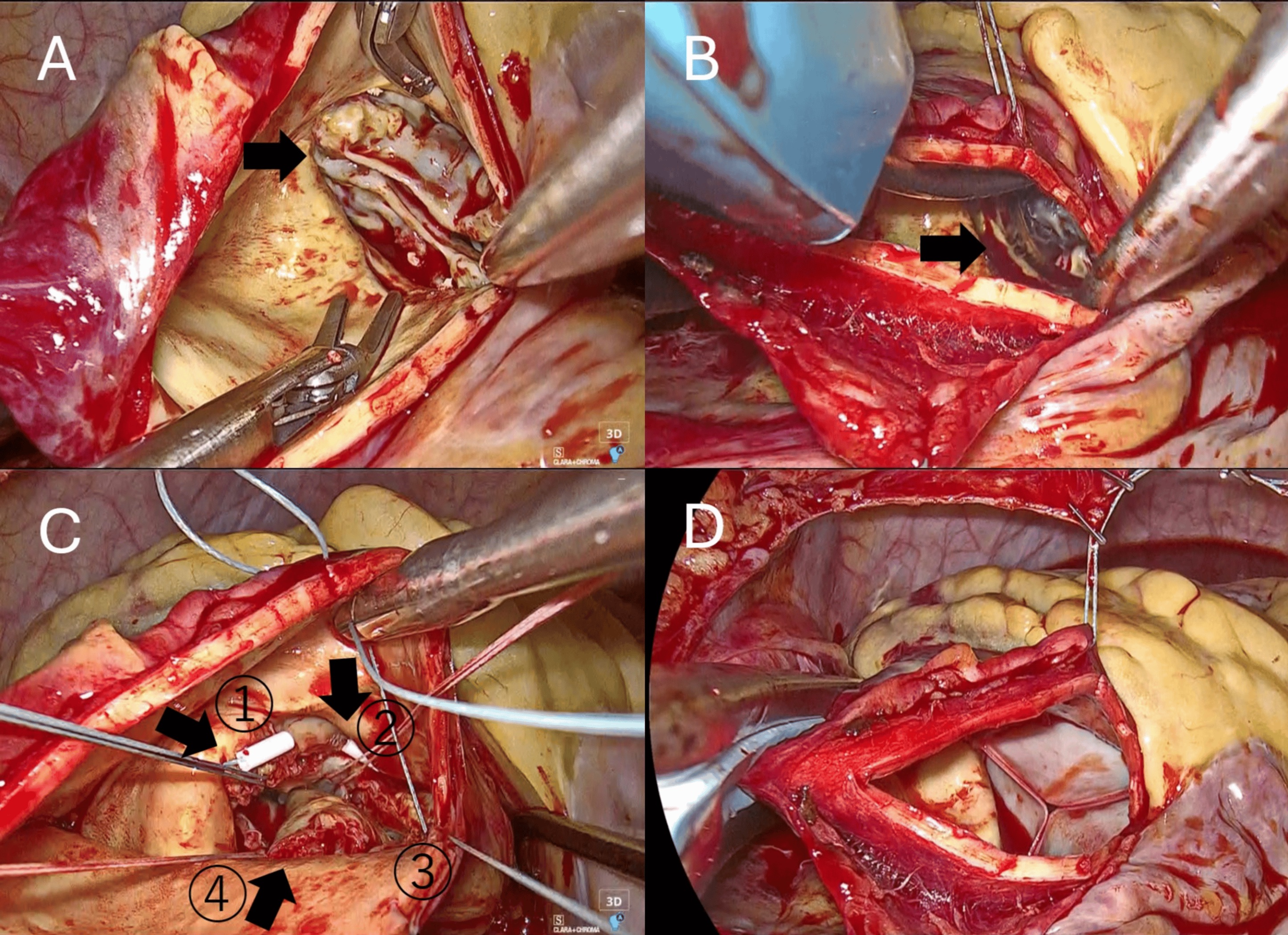 Intraoperative endoscopic views