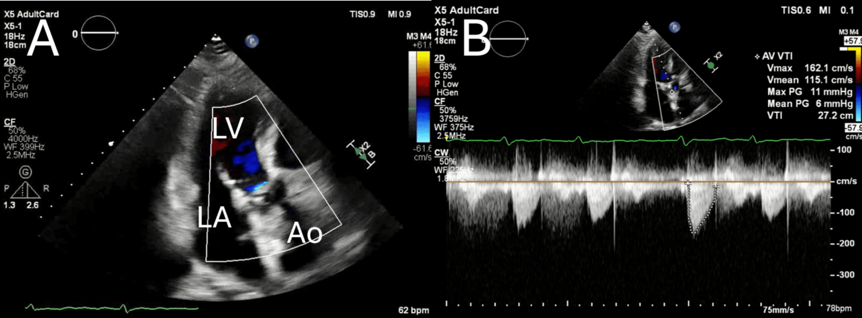 Postoperative transthoracic echocardiography