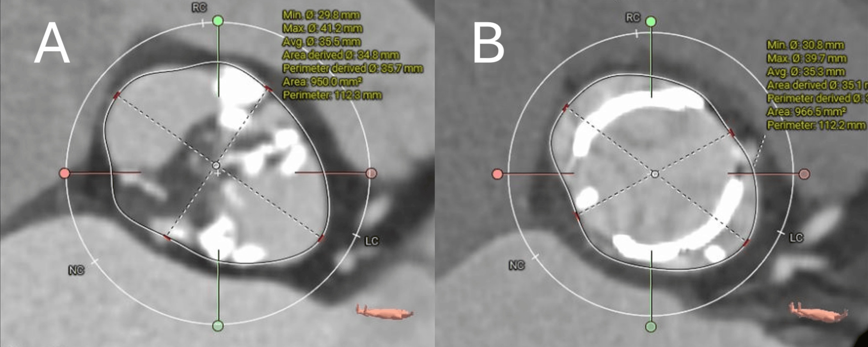 Pre- and postoperative CT curved planar reconstruction at annular level