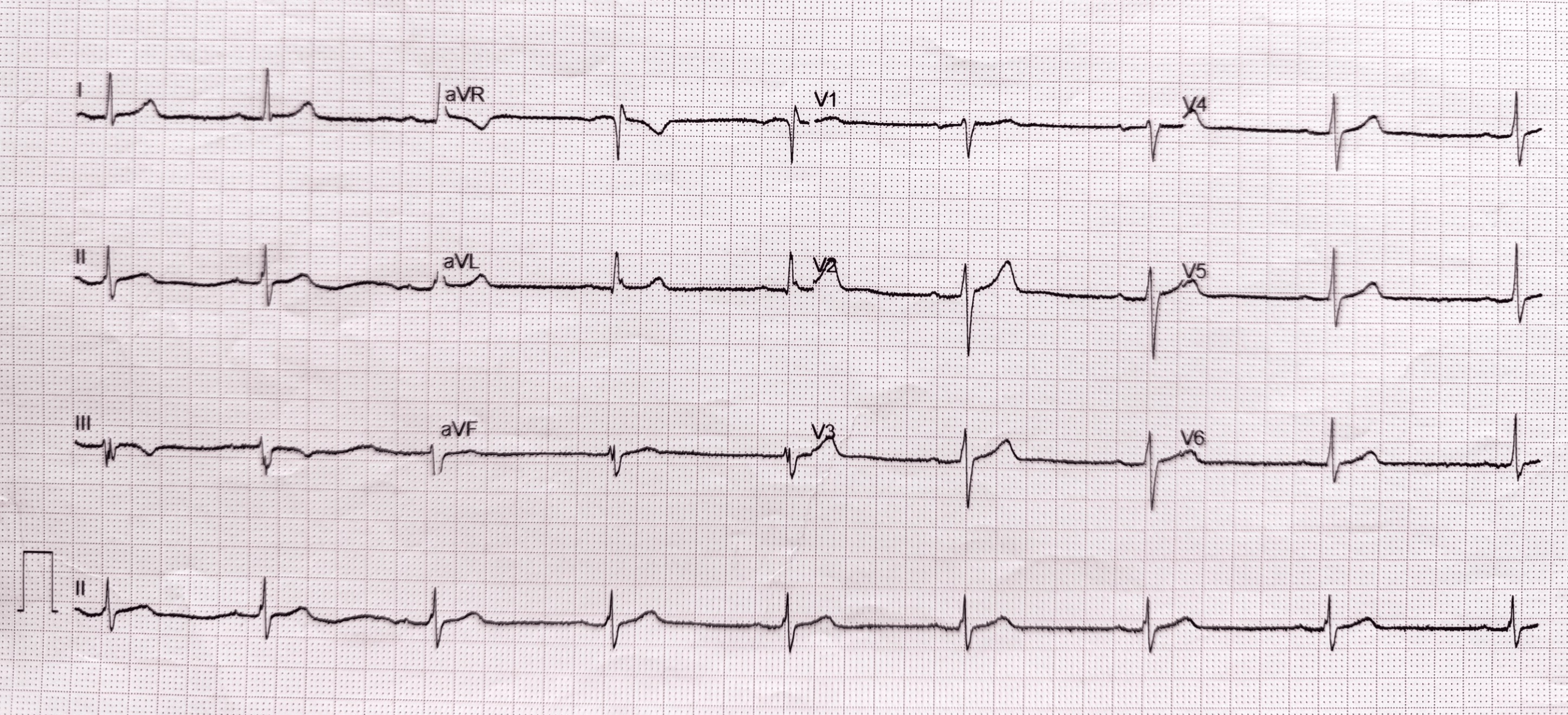 ECG at hospital admission showing sinus bradycardia