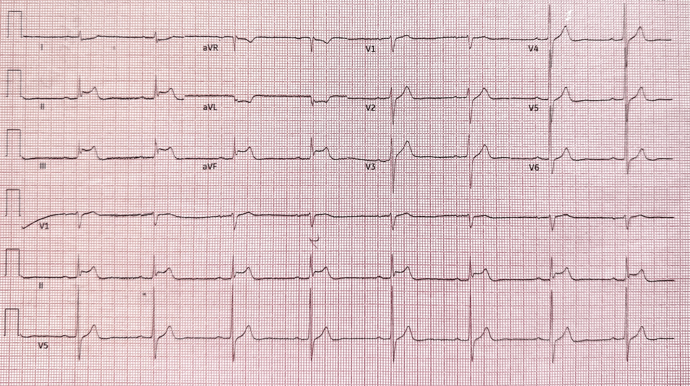 ECG showing inferior ST-segment elevation