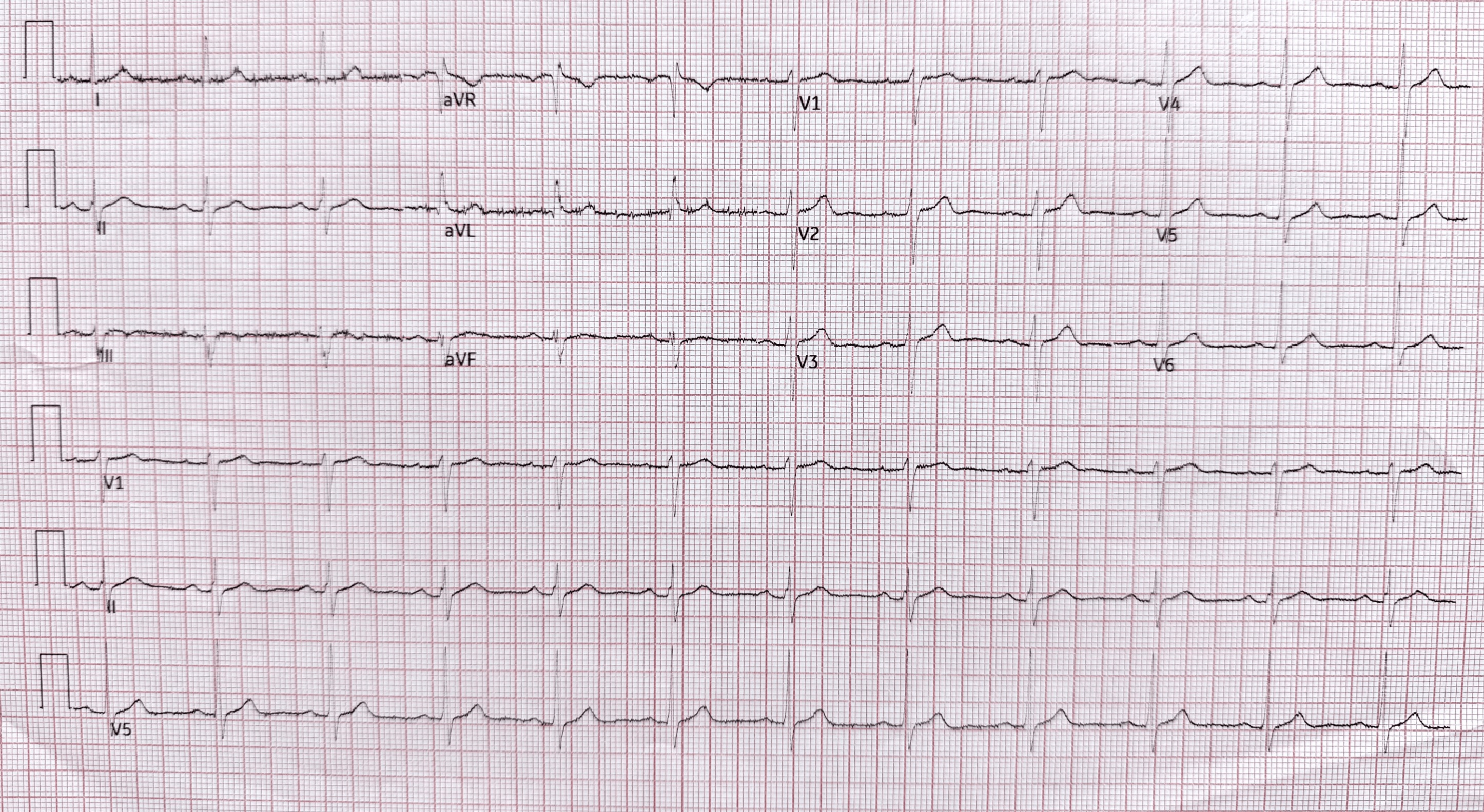 Repeat ECG showing resolution of ST elevation