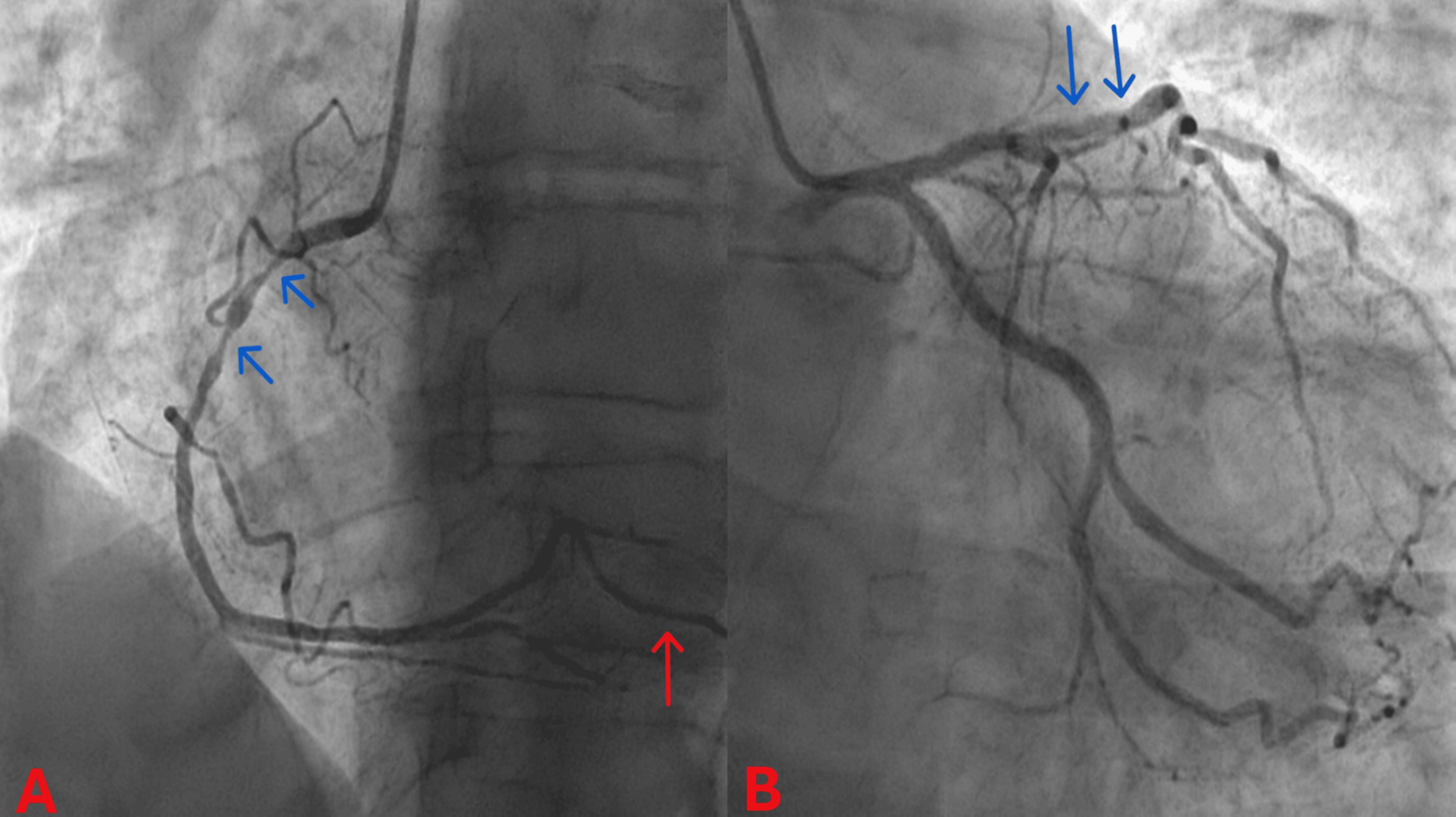 Coronary angiograms before PCI