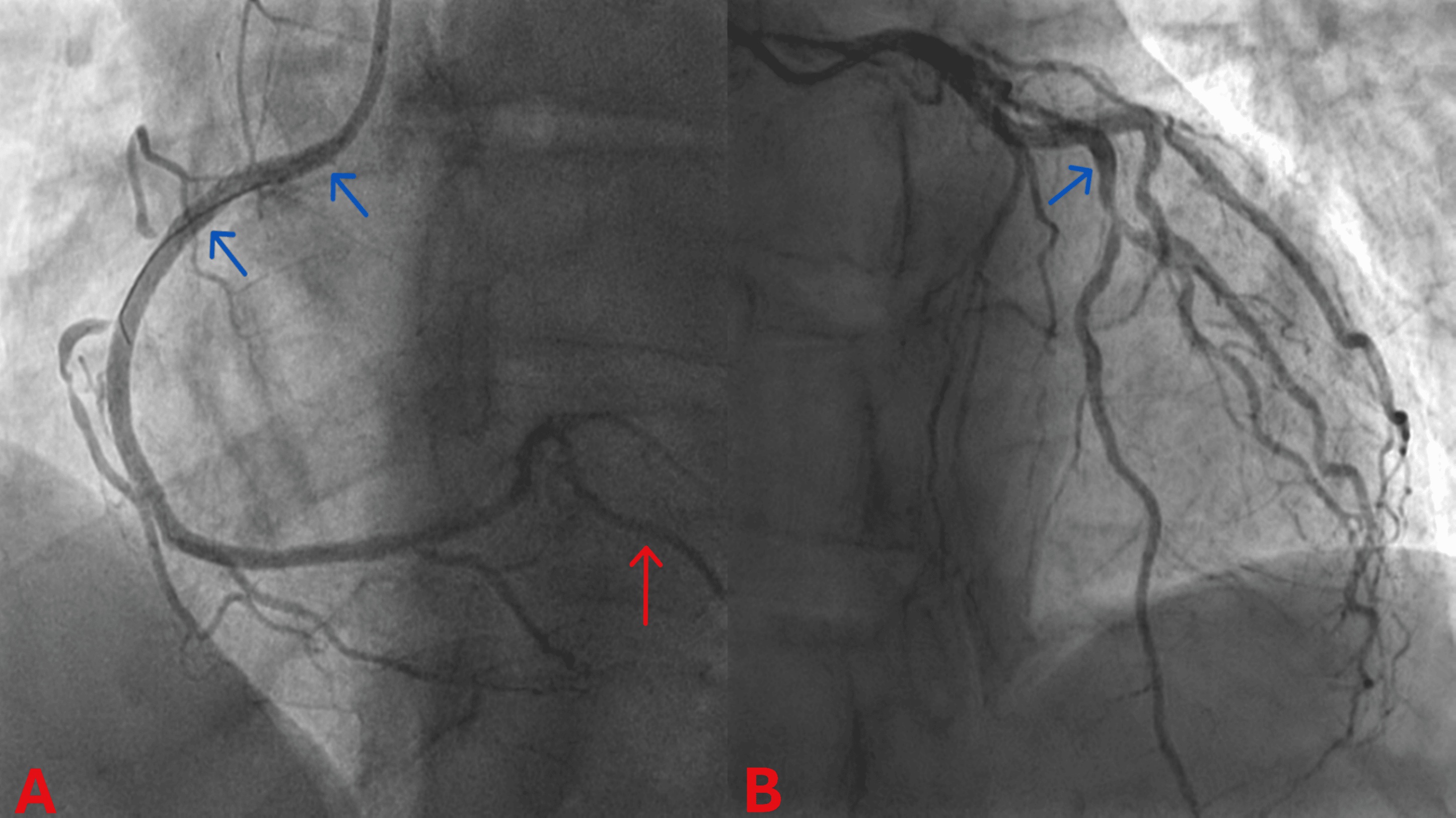 Coronary angiograms after PCI