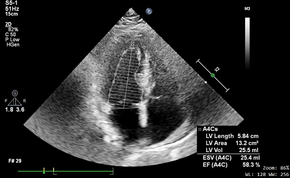 Transthoracic echocardiogram showing preserved LV function