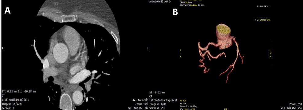 MDCT coronary images showing LMCA occlusion