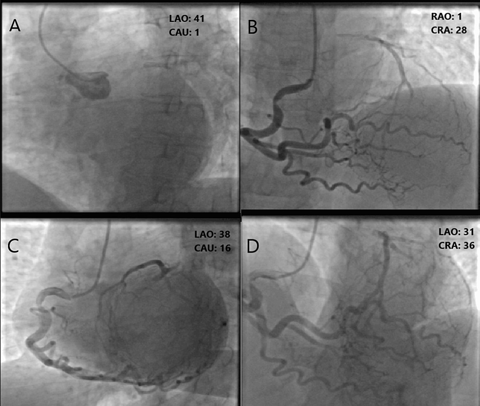 Coronary angiography showing LMCA CTO and RCA collaterals
