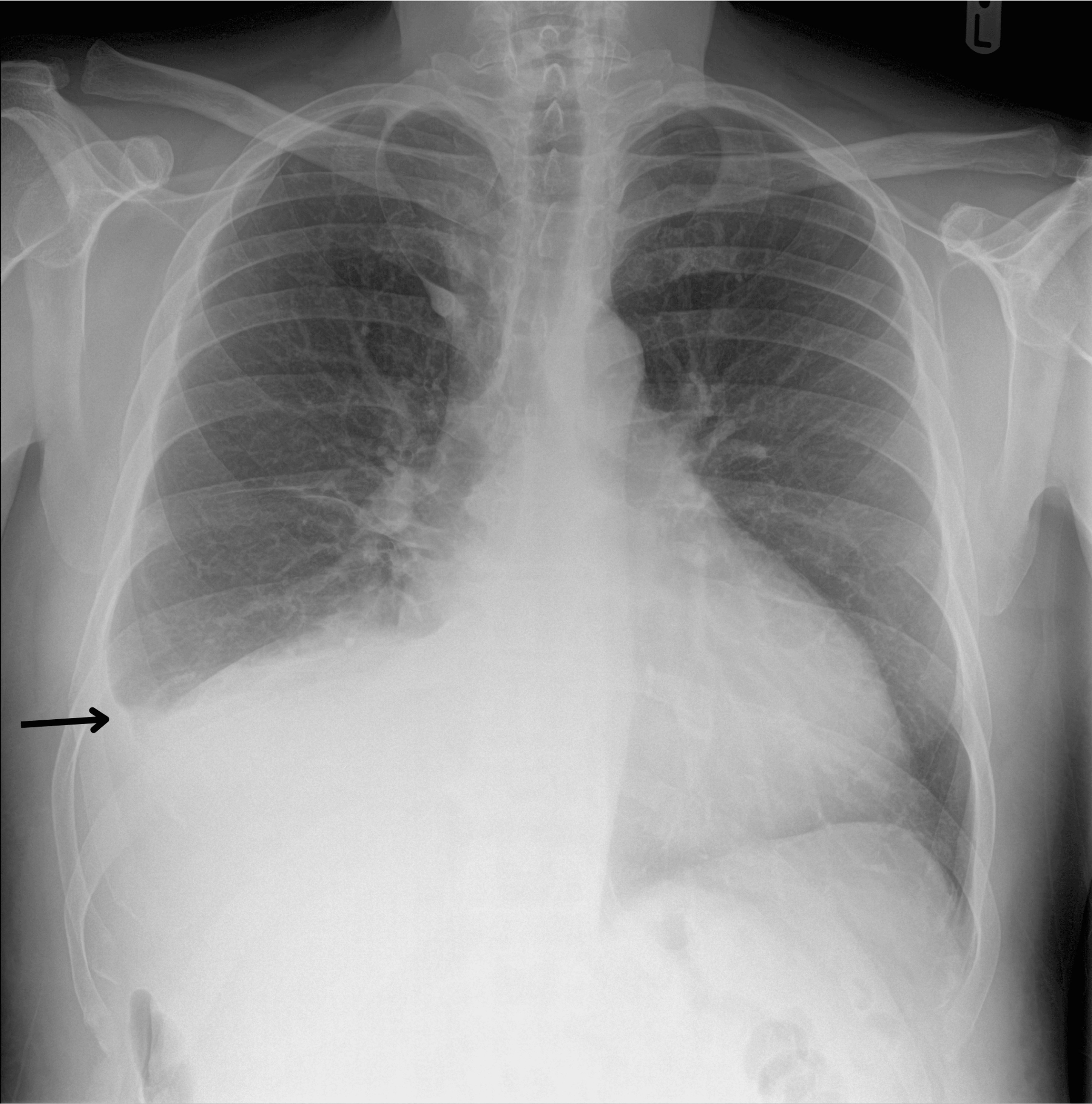 Chest X-ray on admission