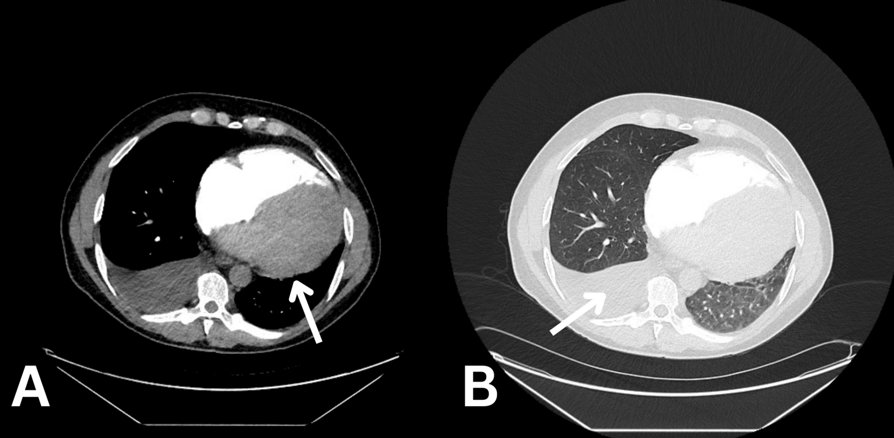 CT-PA showing enlarged heart and pleural effusion