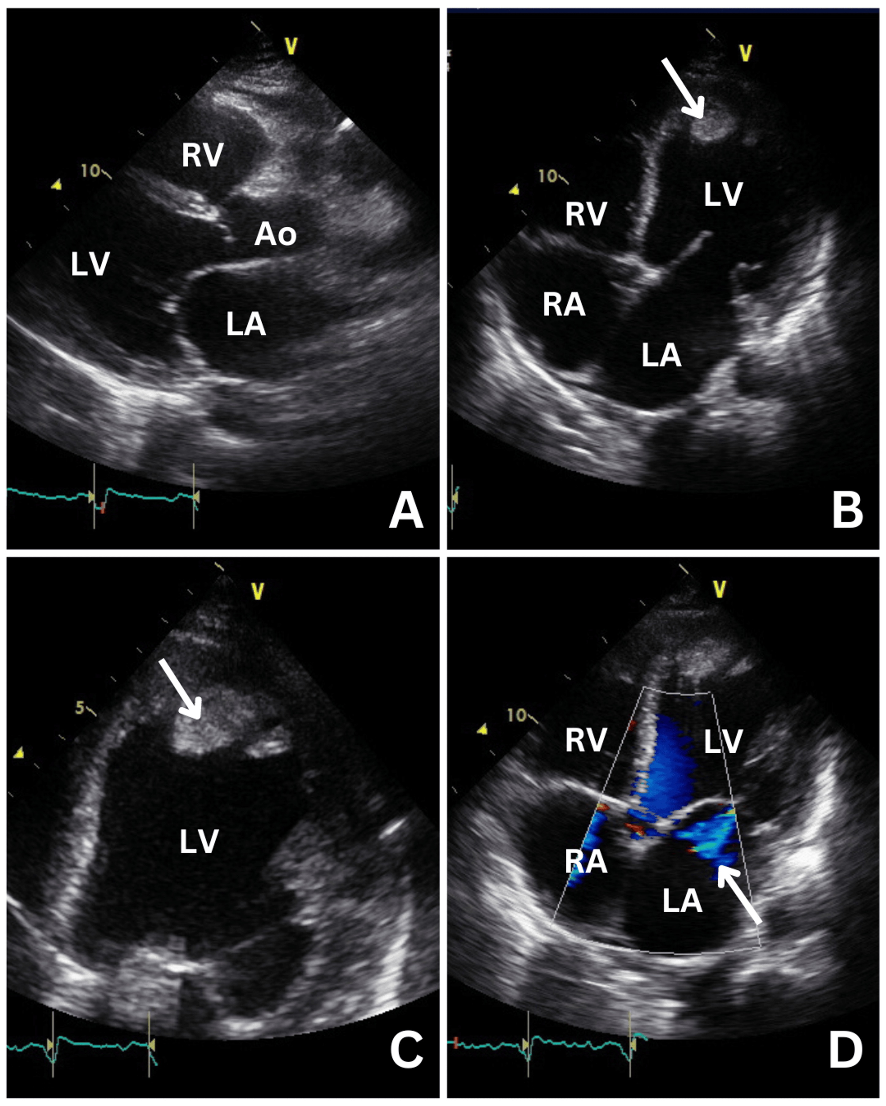 Transthoracic echocardiogram showing severely dilated LV