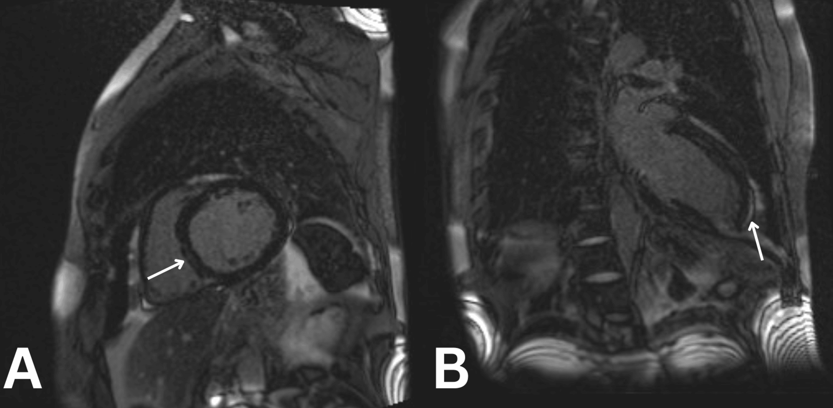 Cardiac MRI showing transmural post-ischaemic scar