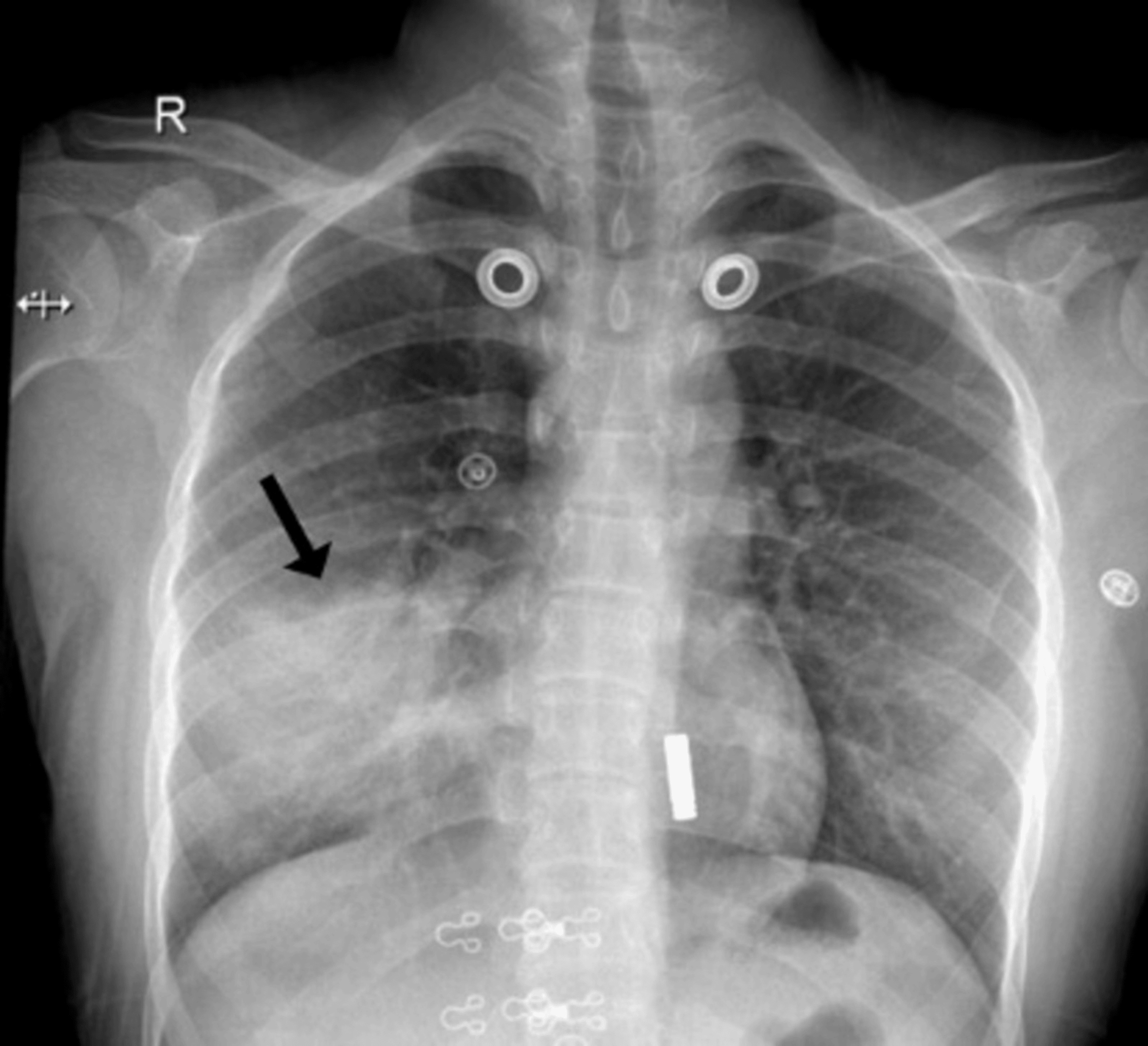 Initial chest radiograph showing right lower zone opacity in COP