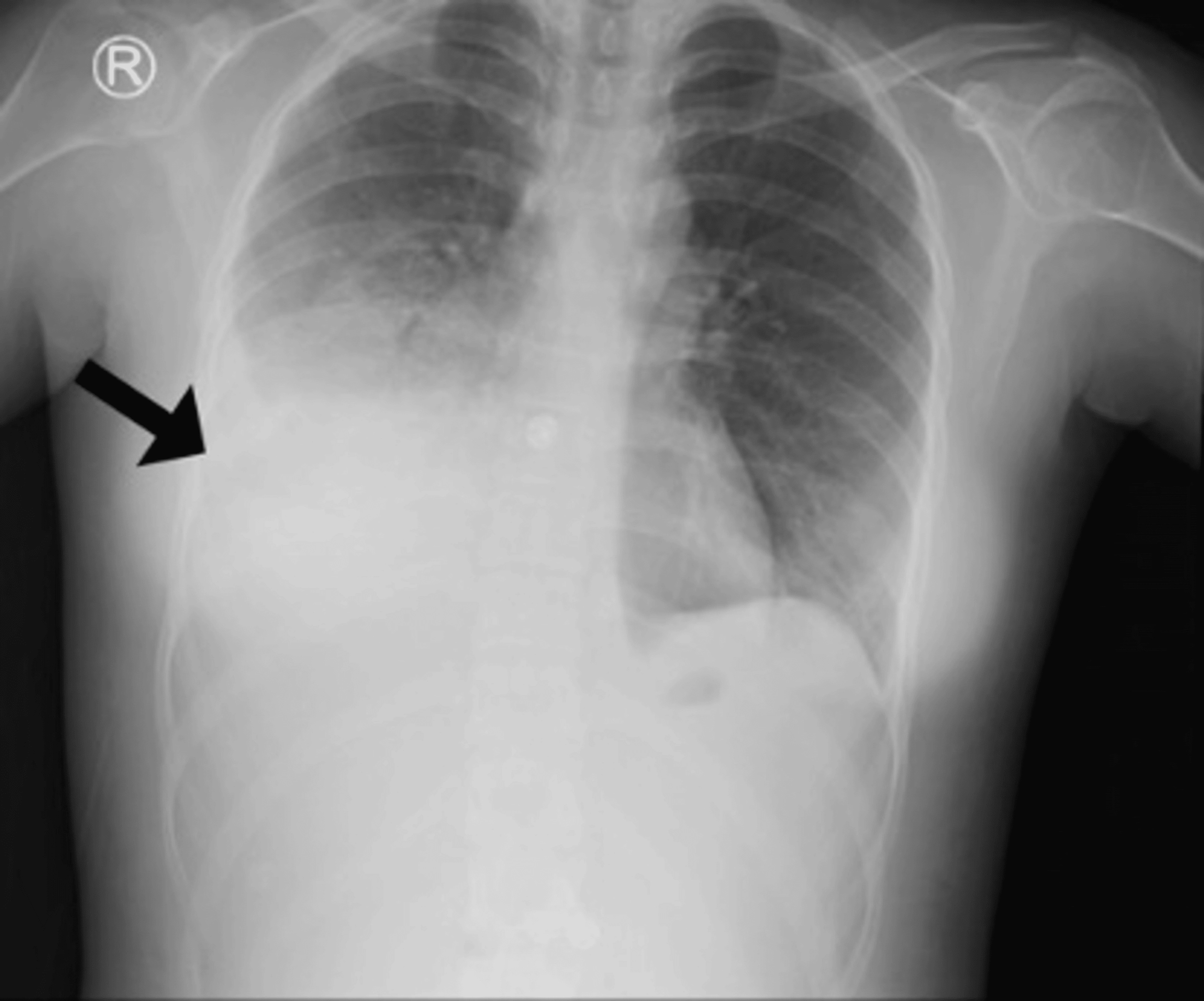 Follow-up chest radiograph showing new pleural effusion obliterating the right costophrenic angle