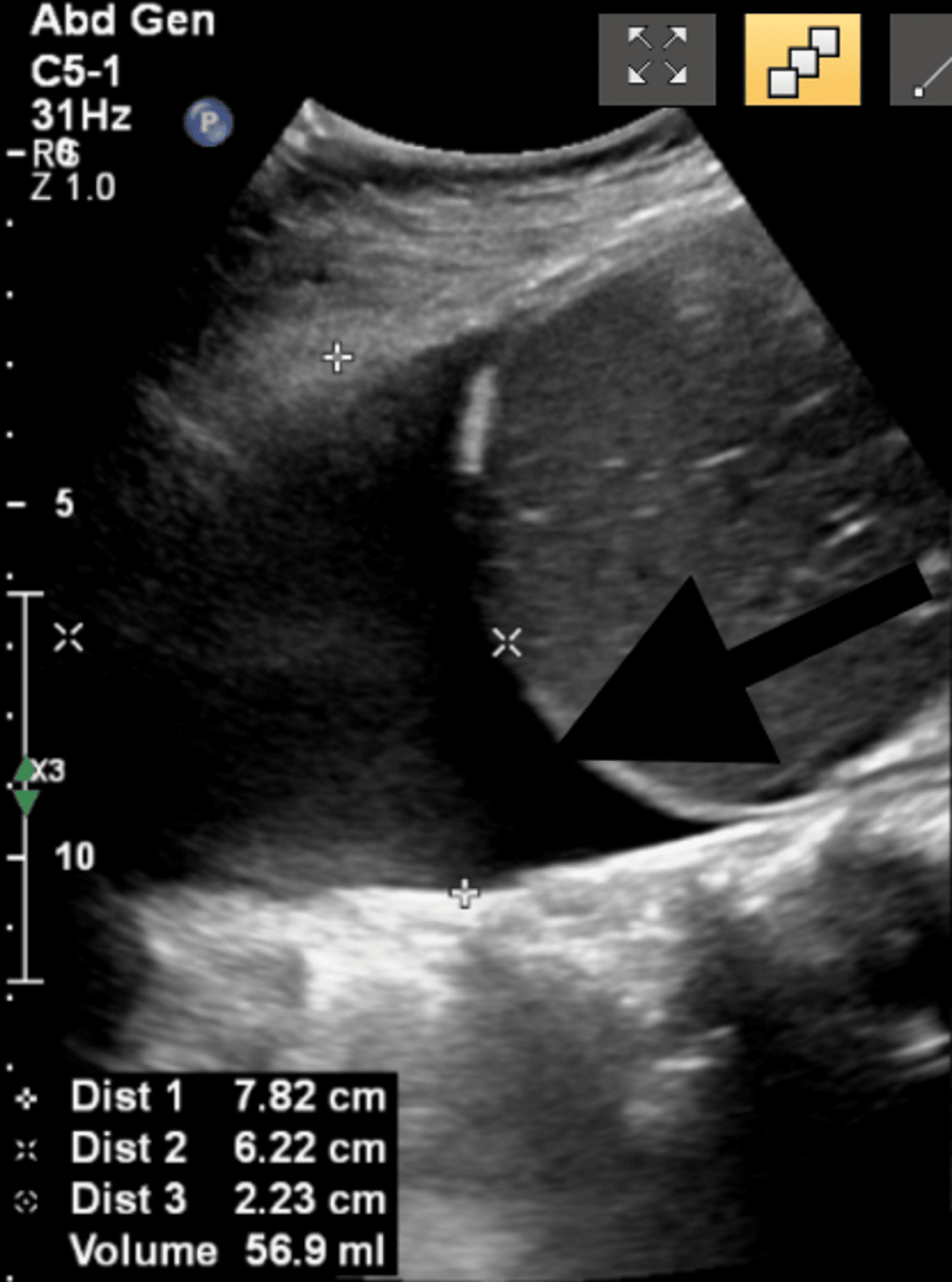 Chest ultrasonography showing right-sided anechoic pleural effusion without septations