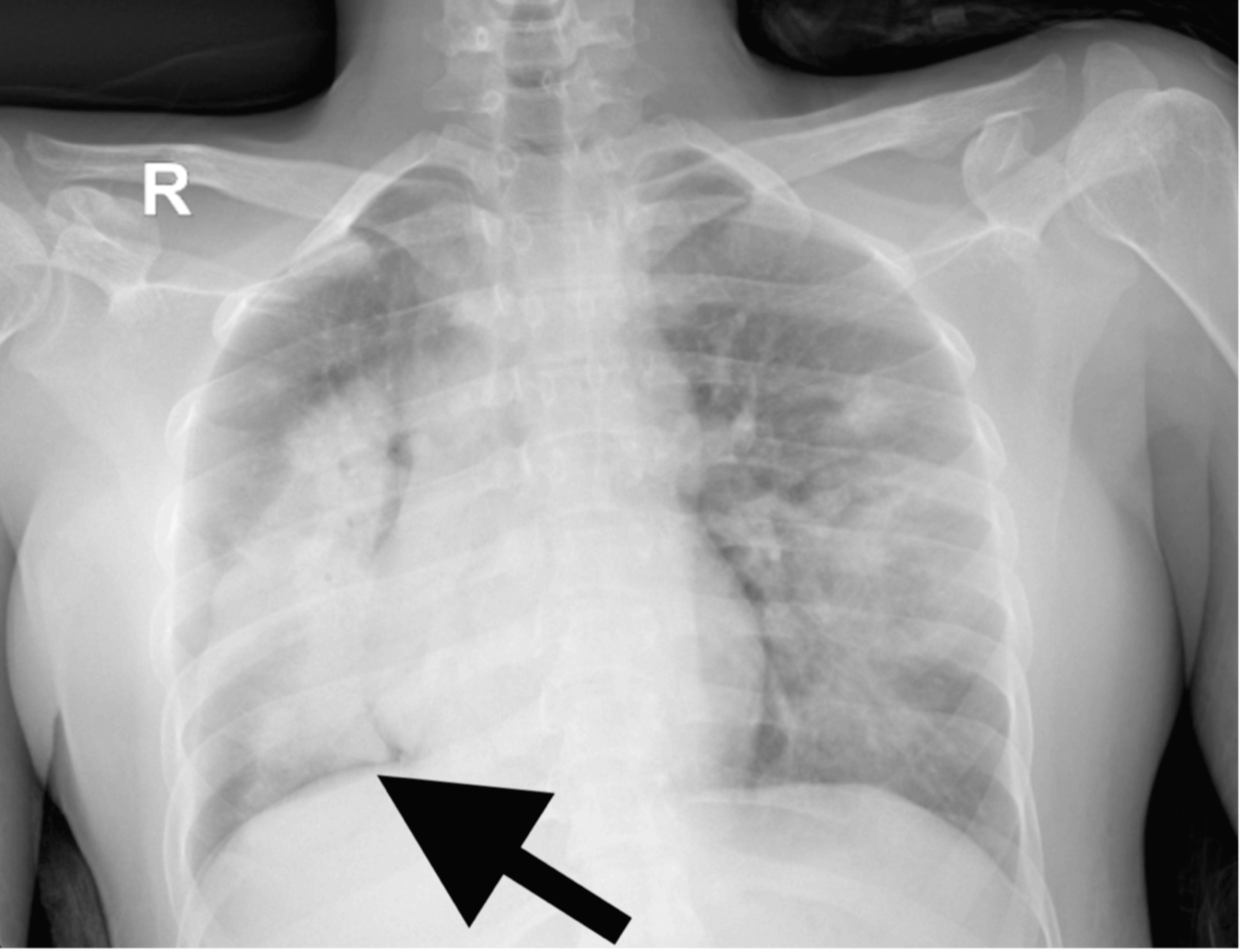 Follow-up radiograph after pigtail removal showing full lung expansion with residual right-sided opacity