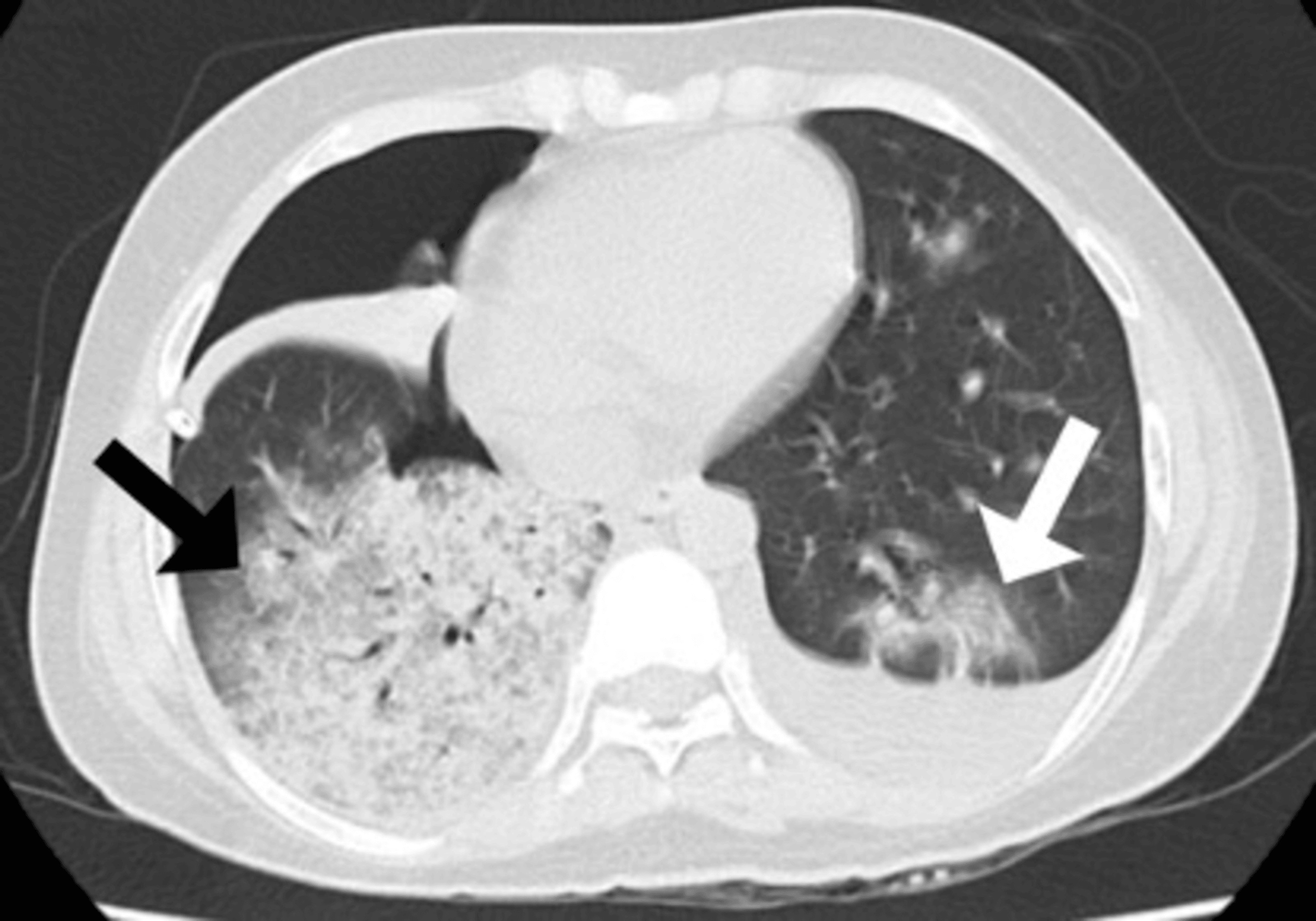 Follow-up CT showing bilateral airspace disease with ground-glass opacities, left pleural effusion, and right pneumothorax