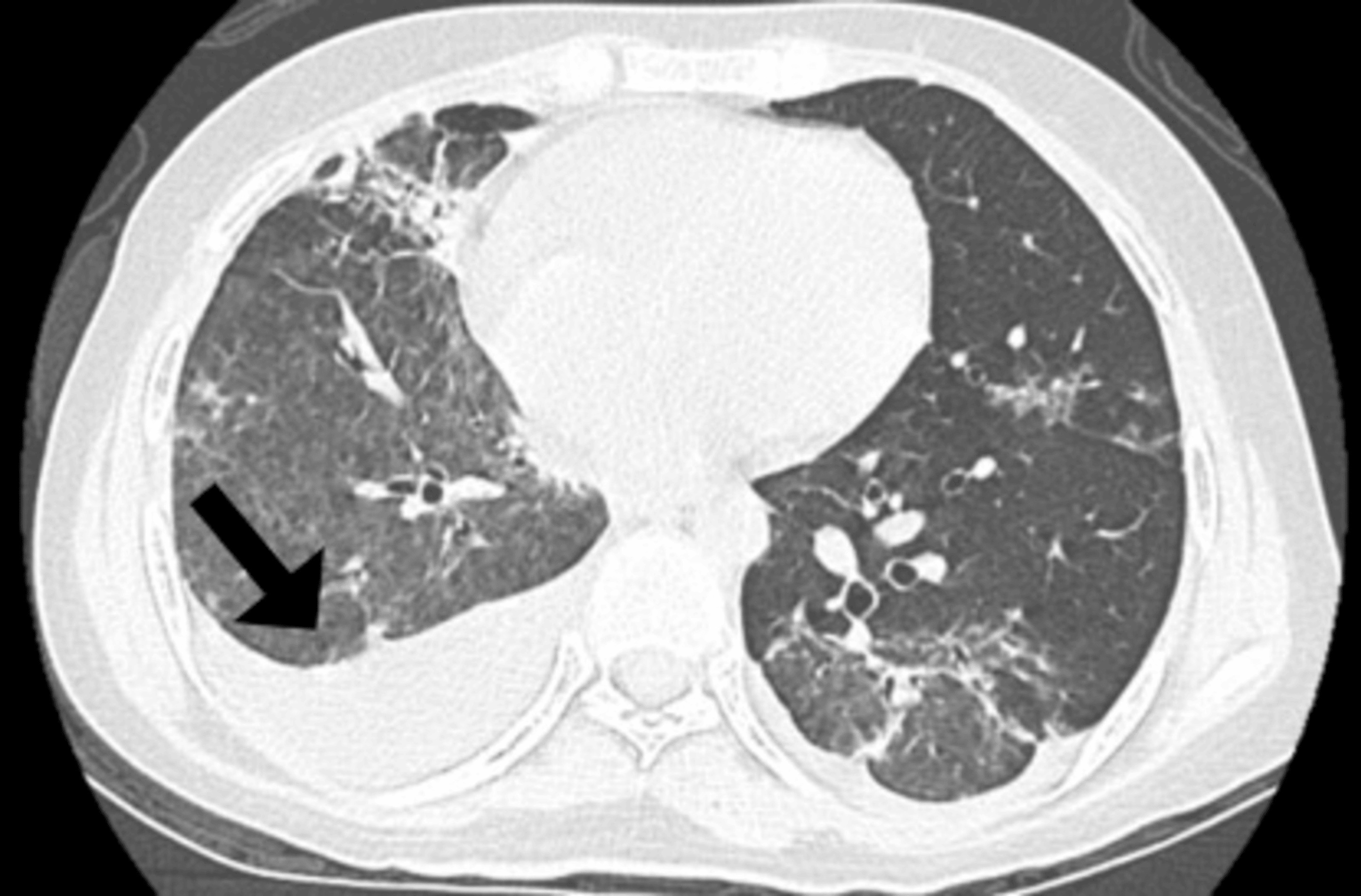 HRCT follow-up showing improvement in bilateral airspace disease with residual ground-glass opacities and right pleural effusion