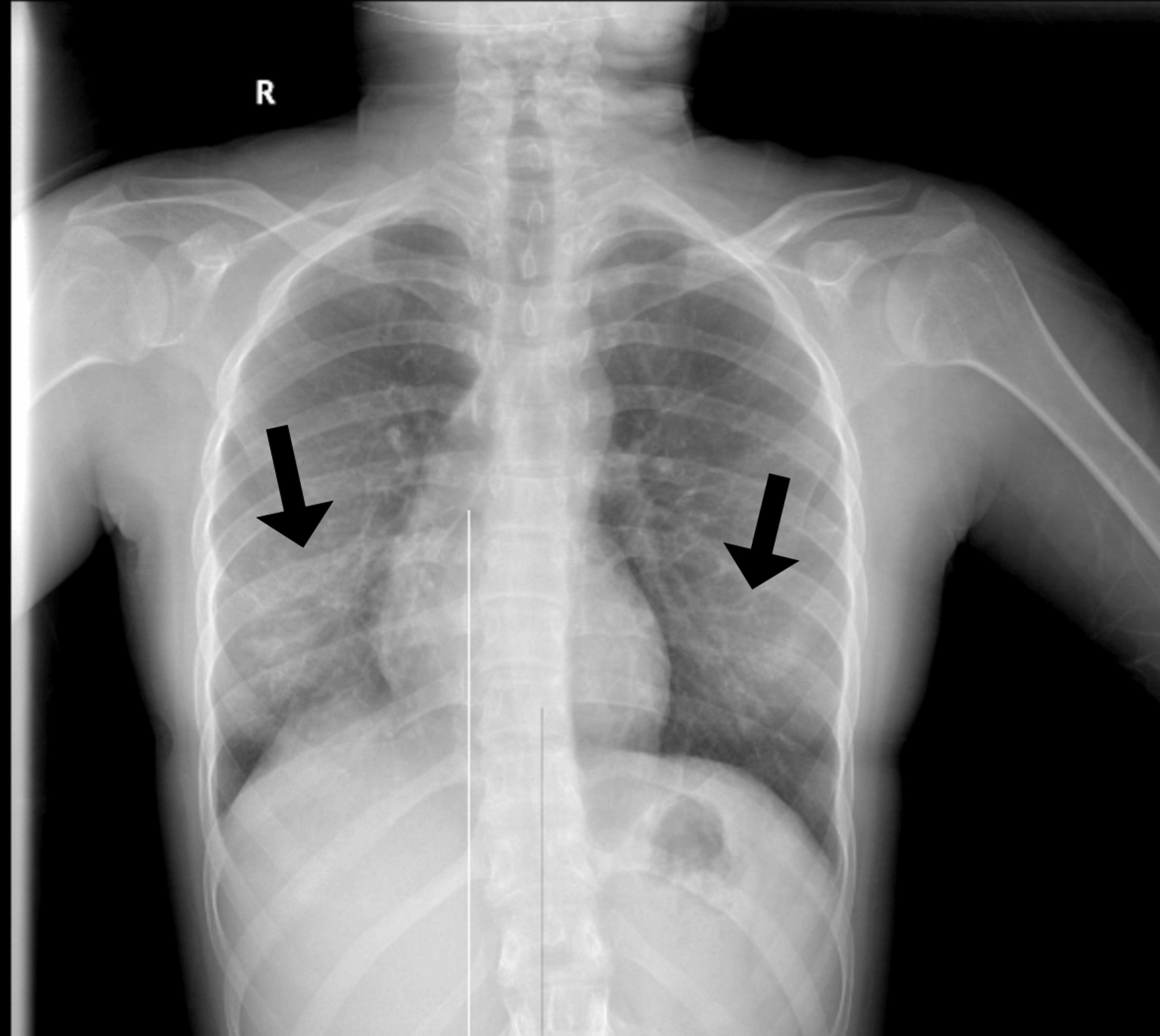 Six-week post-discharge chest radiograph showing complete resolution of bilateral opacities and right pleural effusion