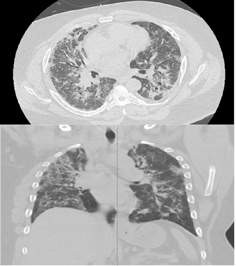 HRCT bilateral peripheral consolidations COP