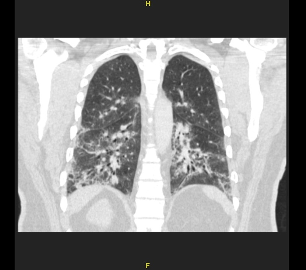 CT chest showing bilateral interstitial infiltrates and bronchiectasis in post-Mycoplasma COP