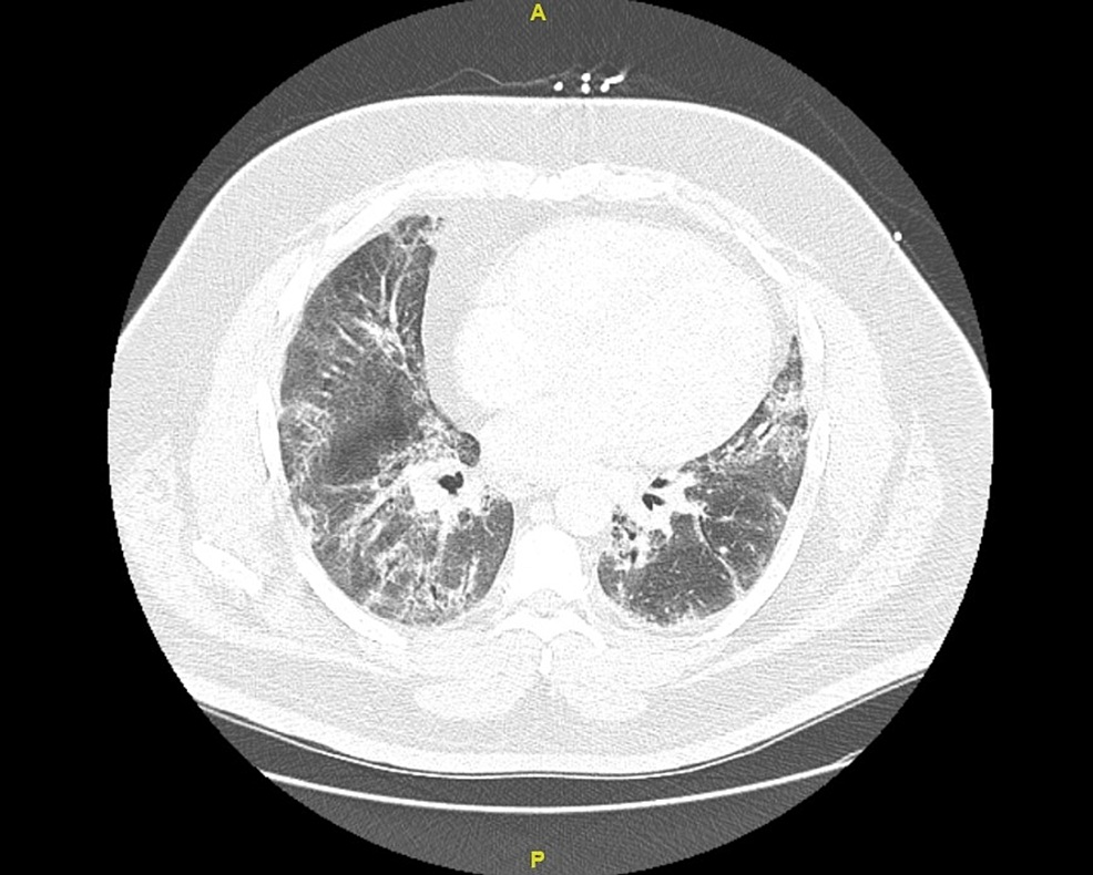CT chest showing development of pulmonary fibrosis and bronchiectasis with peripheral scarring