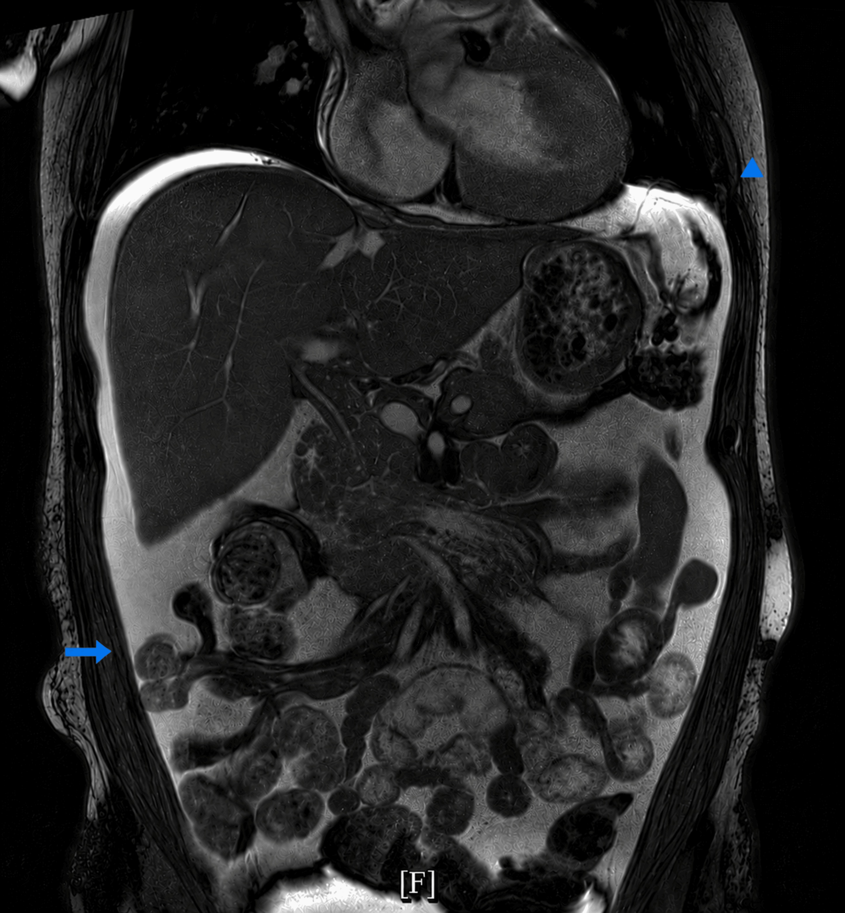 MRCP showing large-volume ascites and right pleural effusion