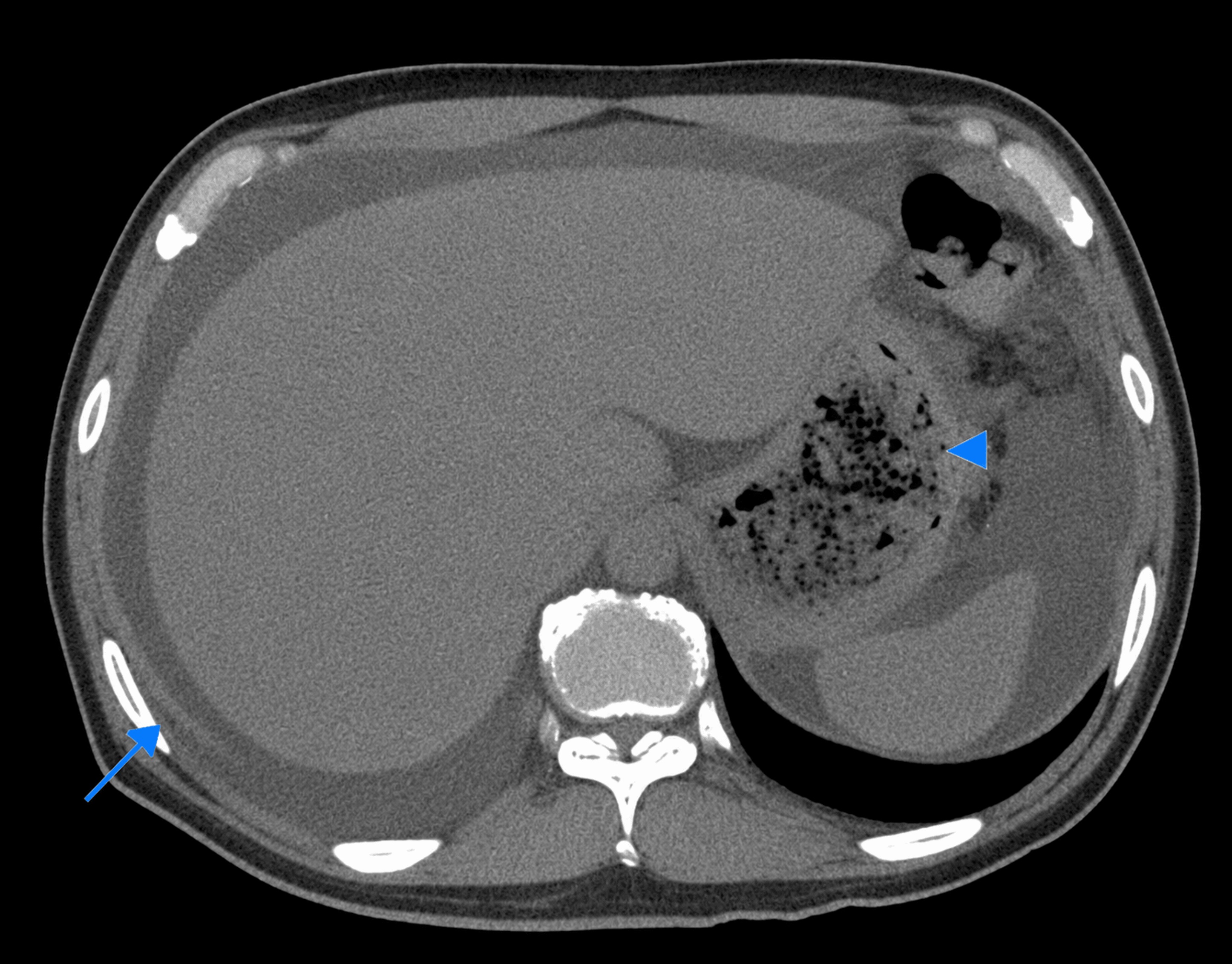 CT abdomen showing abdominopelvic ascites with mesenteric congestion