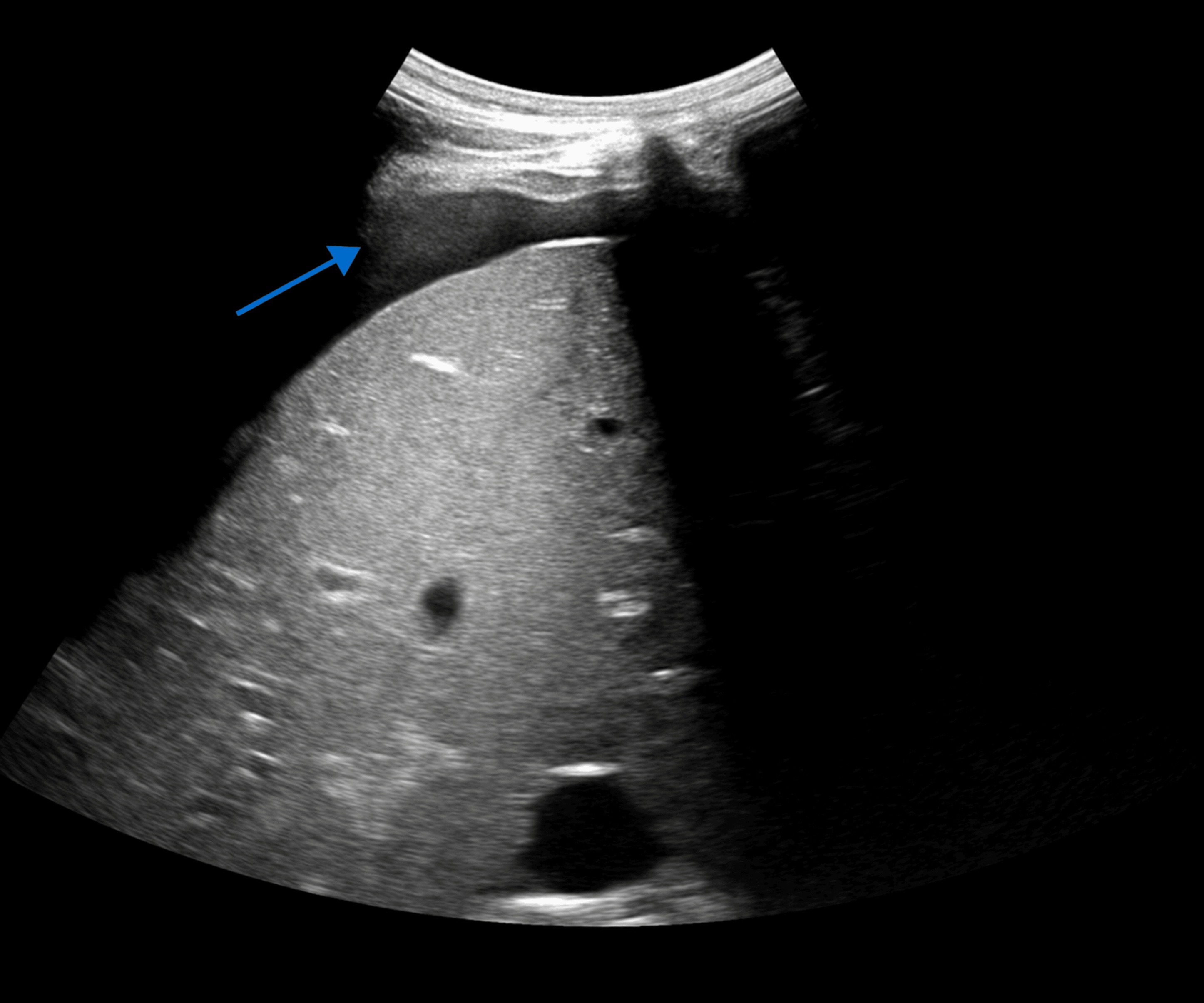 Ultrasound before planned paracentesis showing minimal residual ascites