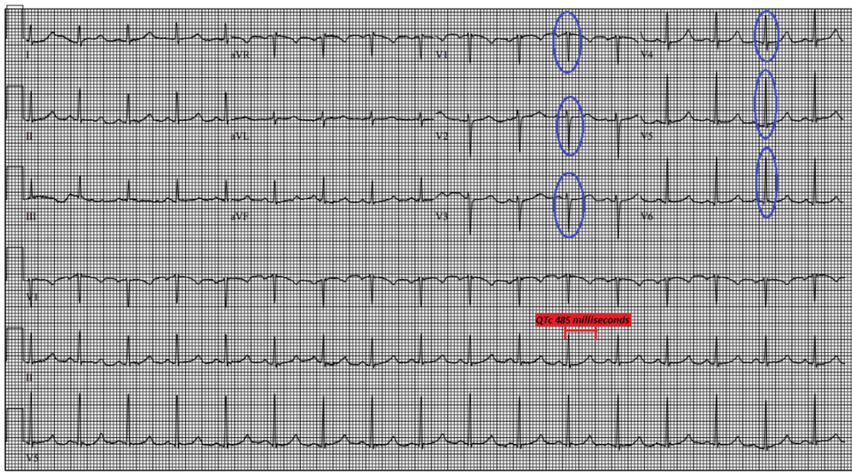 ECG showing poor R-wave progression and long QTc