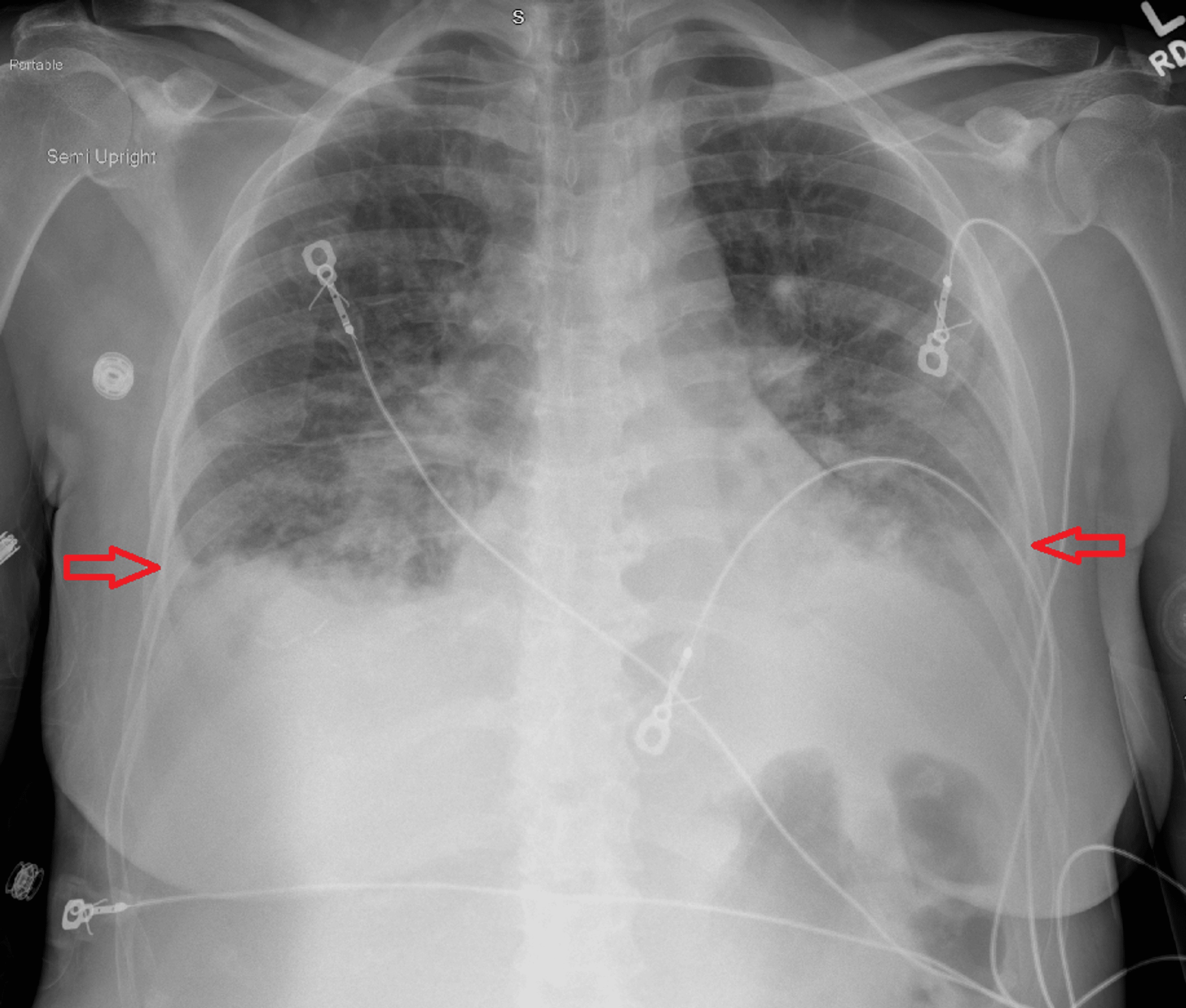 Chest X-ray showing bilateral pleural effusions