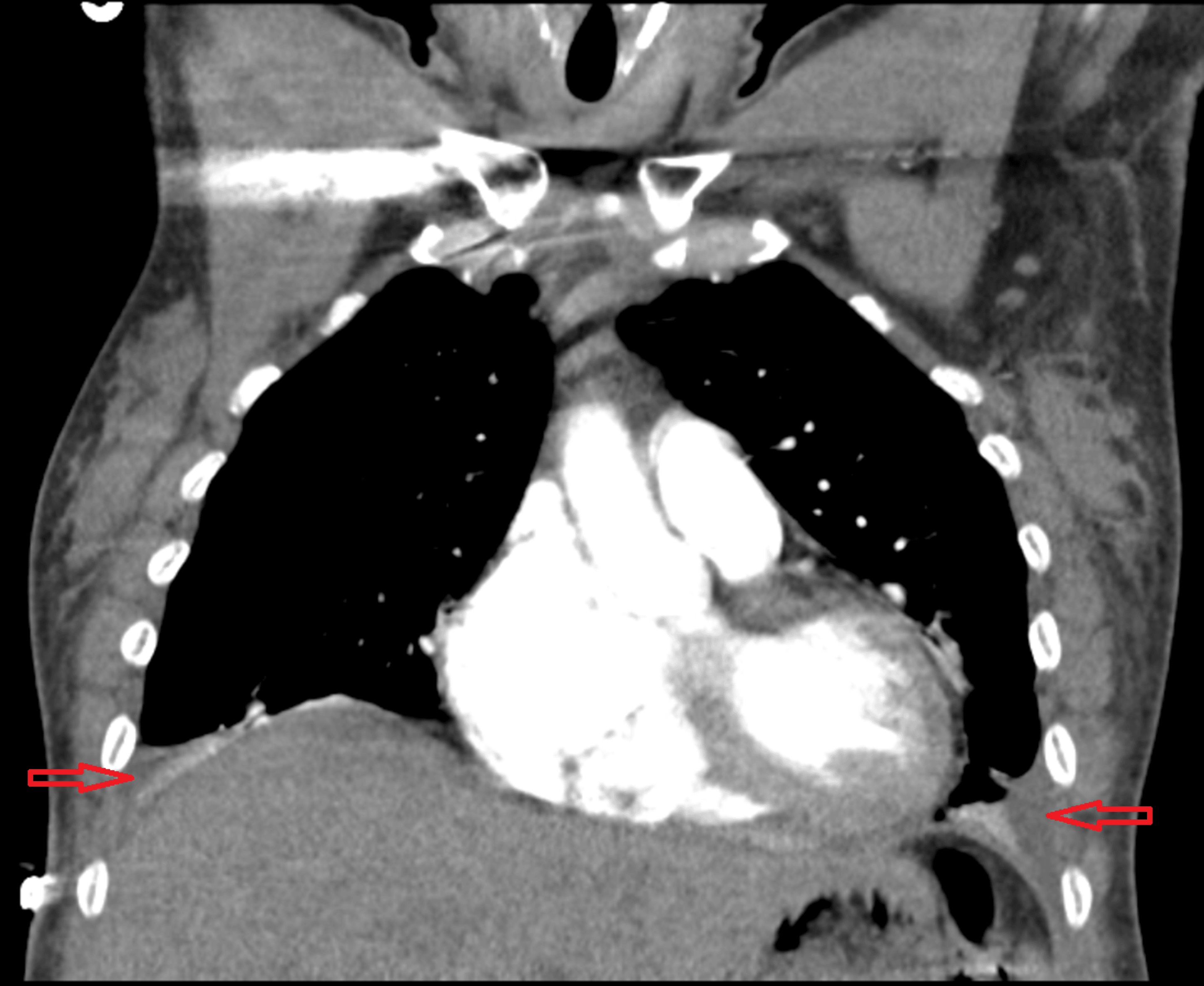 CT chest coronal view showing pleural effusions