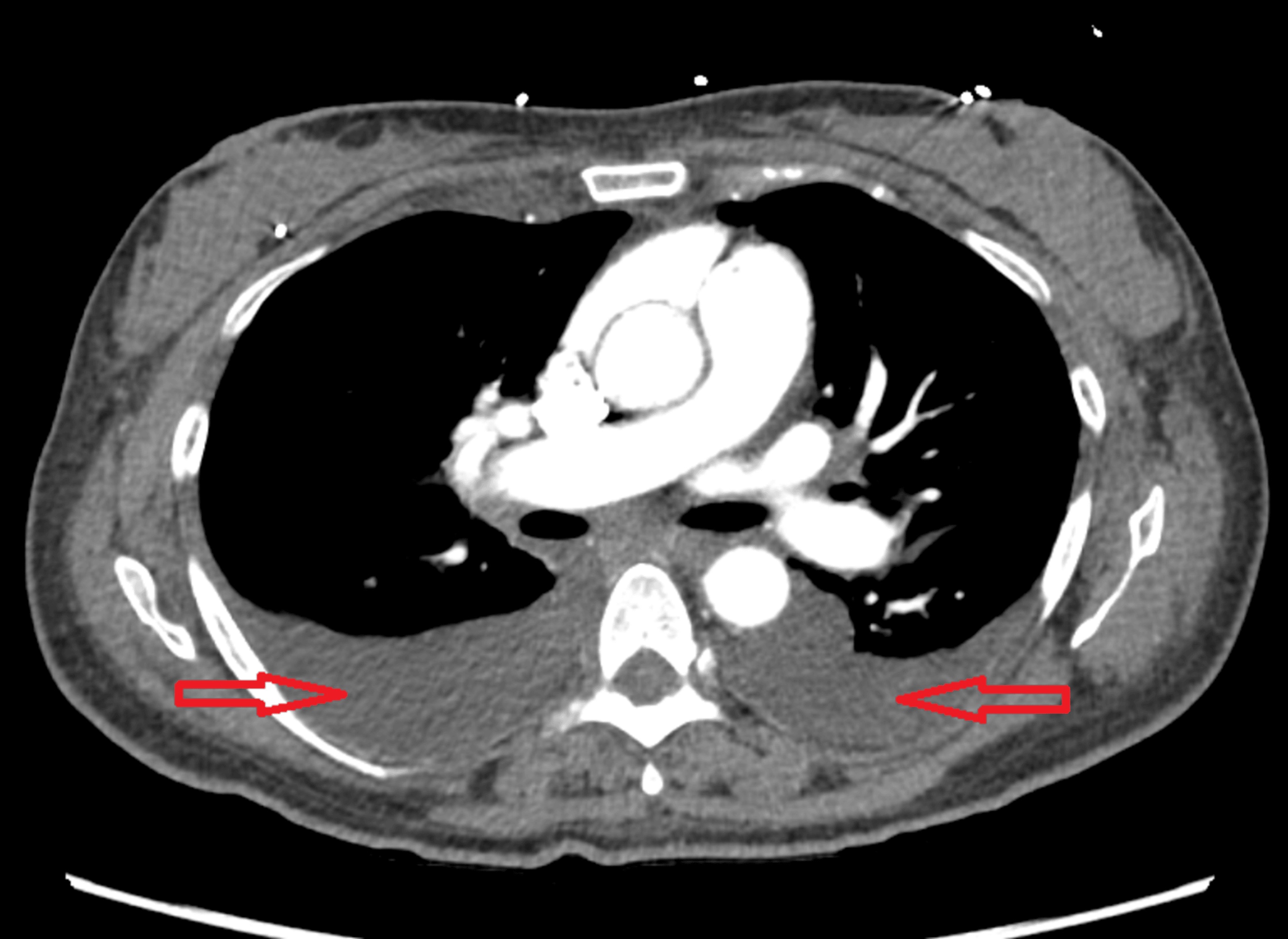 CT chest axial view showing pleural effusions